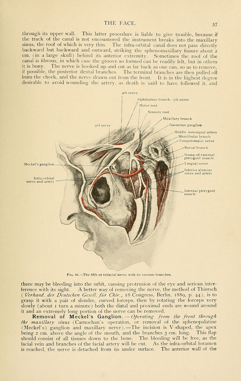 through its upper wall. This latter procedure is liable to give trouble, because if the track of the canal is not encountered the instrument breaks into the maxillary- sinus, the roof of which is very thin. The infra-orbital canal does not pass direcdy backward but backward and outward, striking the sphenomaxillary fissure about 2 cm. (in a large skull) behind its anterior extremity. Sometimes the roof of the canal is fibrous, in which case the groove so formed can be readily felt, but in others it is bony. The nerve is hooked up and cut as far back as one can, so as to remove, if possible, the posterior dental branches. The terminal branches are then pulled off from the cheek, and the nerve drawn out from the front. It is in the highest degree desirable to avoid wounding the artery, as death is said to have followed it, and •^ iniffMW^'°- Ophtha Iniic branch- -Sih nerve Motor root 1 Sensory root / Ma. lary branch 1/. asser,an ganglion ^ ^.'<^ ^,_^-^\^^^^ -'Middle niening^eal artery ^ Mandibular branch ^^Temporomalar nt^rve ^^-^ Buccal branch ^ter^*^^-^ \ Stump of external -i--''^ pterygoid muscle ^^^--Lingual nerve __ Inferior alveolar Infra-orbital nerve and arterj ' ^ZA Fig. 66.—The fifth or trifacial nerve with its various branches. there may be bleeding into the orbit, causing protrusion of the eye and serious inter- ference with its sight. A better way of removing the nerve, the method of Thiersch ( Verhand. der Deiitschen Gesell. fiir Chir., 18 Congress, Berlin, 1S89, p. 44J, is to grasp it with a pair of slender, curved forceps, then by rotating the forceps very slowly (about i turn a minute) both the distal and proximal ends are wound around it and an extremely long portion of the nerve can be removed. Removal of Meckel's Ganglion. — Operating from the front through the maxillary sinics (Carnochan's operation, or removal of the sphenopalatine (Meckel's) ganglion and maxillary nerve).—The incision is V-shaped, the apex being 2 cm. above the angle of the mouth, and the branches 3 cm. long. This flap should consist of all tissues down to the bone. The bleeding will be free, as the facial vein and branches of the facial artery will be cut. As the infra-orbital foramen is reached, the nerve is detached from its under surface. The anterior wall of the