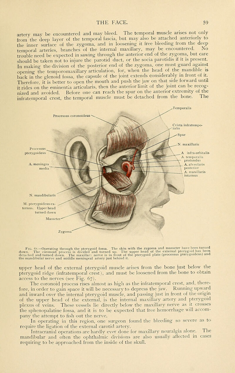 artery may be encountered and may bleed. The temporal muscle arises not only from the deep layer of the temporal fascia, but may also be attached anteriorly to the inner surface of the zygoma, and in loosening it free bleeding from the deep temporal arteries, branches of the internal ma.xillary, may be encountered. No trouble need be expected in sawing through the anterior end of the zygoma, but care should be taken not to injure the parotid duct, or the socia parotidis if it is present. In making the division of the posterior end of the zygoma, one must guard against opening the temporomaxillary articulation, for, when the head of the mandible is back in the glenoid fossa, the capsule of the joint extends considerably in front of it Therefore, it is better to open the mouth and push the jaw on that side forward until it rides on the eminentia articularis, then the anterior limit of the joint can be recog- nized and avoided. Before one can reach the spur on the anterior extremity of the infratemporal crest, the temporal muscle must be detached from the bone. The Processus coronoideus Crista iiifratempo- Spur ixillaris A infra-orbitalis A. temporalis proluiidus A. alveolaris posterior A. maxiUaris interims M. ptery ternus. Upper head turned down Fig. 67.—Operating through the pterygoid fossa. The skin with the zygoma and masseter have been turned down. The coronoid process is divided and turned up. The upper head of the external pterygoid has been detached and turned down. The maxillary nerve is in front of the pterygoid plate (processus pterygoideus) and the mandibular nerve and middle meningeal artery just behind it. Upper head of the external pterygoid muscle arises from the bone just below the pterygoid ridge (infratemporal crest), and must be loosened from the bone to obtain access to the nerves (see Fig. 67). The coronoid process rises almost as high as the infratemporal crest, and, there- fore, in order to gain space it will be necessary to depress the jaw. Running upward and inward over the internal pterygoid muscle, and passing just in front of the origin of the upper head of the external, is the internal maxillary artery and pterygoid plexus of veins. These vessels lie directly below the maxillary nerve as it crosses the sphenopalatine fossa, and it is to be expected that free hemorrhage will accom- pany the attempt to fish out the nerve. In operating in this region, one surgeon found the bleeding so severe as to require the ligation of the e-xternal carotid artery. Intracranial operations are hardly ever done for maxillary neuralgia alone. The mandibular and often the ophthalmic divisions are also usually affected in cases requiring to be approached from the inside of the skull.