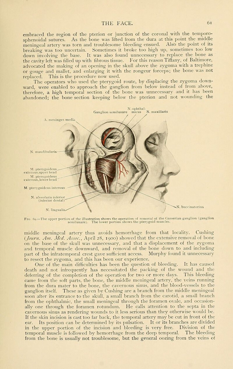 embraced the region of the pterion or junction of the coronal with the temporo- sphenoidal sutures. As the bone was lifted from the dura at this point the middle meningeal artery was torn and troublesome bleeding ensued. Also the point of its breaking was too uncertain. Sometimes it broke too high up, sometimes too low down involving the base. It was also found unnecessary to replace the bone as the cavity left was filled up with fibrous tissue. For this reason Tiffany, of Baltimore, advocated the making of an opening in the skull above the zygoma with a trephine or gouge and mallet, and enlarging it with the rongeur forceps; the bone was not replaced. This is the procedure now used. The operators who used the pterygoid route, by displacing the zygoma down- ward, were enabled to approach the ganglion from below instead of from above, therefore, a high temporal section of the bone was unnecessary and it has been abandoned; the bone section keeping below the pterion and not wounding the J\I. ptery_ extern us, upper head M. pteryi exteriius,low M. pterygoideus N. alveolaris inferior (inferior dental) Fig. 69.—The upper porti( 1 of the illustration shows the operation of removal of the Gasserii emilunare). The lower portion shows the pterygoid muscles. middle meningeal artery thus avoids hemorrhage from that locality. Gushing {Journ. Am. Med. Assoc, April 28, 1900) showed that the extensive removal of bone on the base of the skull was unnecessary, and that a displacement of the zygoma and temporal muscle downward, and removal of the bone down to and including part of the infratemporal crest gave sufhcient access. Murphy found it unnecessary to resect the zygoma, and this has been our experience. One of the main difficulties has been the question of bleeding. It has caused death and not infrequently has necessitated the packing of the wound and the deferring of the completion of the operation for two or more days. This bleeding came from the soft parts, the bone, the middle meningeal artery, the veins running from the dura mater to the bone, the cavernous sinus, and the blood-\-essels to the ganglion itself. These as given by Gushing are a branch from the middle meningeal soon after its entrance to the skull, a small branch from the carotid, a small branch from the ophthalmic, the small meningeal through the foramen ovale, and occasion- ally one through the foramen rotundum. He calls attention to the septa in the cavernous sinus as rendering wounds to it less serious than they otherwise would be. If the skin incision is cast too far back, the temporal artery may be cut in front of the ear. Its position can be determined by its pulsation. It or its branches are divided in the upper portion of the incision and bleeding is very free. Division of the temporal muscle is followed by hemorrhage from the deep temiporal. The bleeding from the bone is usually not troublesome, but the general oozing from the veins of