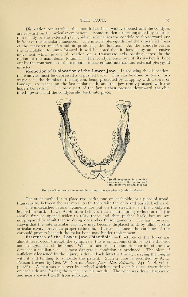 Dislocation occurs when the mouth has been widely opened and the condyles are forward on the articular eminences. Some sudden jar accompanied by contrac- tion mainly of the external pterygoid muscle causes the condyle to slip forward just in front of the articular eminences. The internal pterygoids and the superficial fibres of the masseter muscles aid in producing the luxation. As the condyle leaves the articulation to jump forward, it will be noted that it does so by an extensive movement, which is one of rotation on a transverse axis passing across in the region of the mandibular foramina. The condyle once out of its socket is kept out by the contraction of the temporal, masseter, and internal and external pterygoid muscles. Reduction of Dislocation of the Lower Jaw.—In reducing the dislocation, the condyles must be depressed and pushed back. This can be done by one of two ways: viz., the thumbs of the surgeon, being protected by wrapping with a towel or bandage, are placed on the last molar teeth, and the jaw firmly grasped with the fingers beneath it. The back part of the jaw is then pressed downward, the chin tilted upward, and the condyles slid back into place. Fig. 77.—Fracture of the Small fragment into which was inserted the geniohyoid and geniohyoglosbus muscles luiihle through the symphysis (author's sketch). The other method is to place two corks, one on each side, or a piece of wood, transversely, between the last molar teeth, then raise the chin and pusl> it backward. The undetached lateral ligaments are put on the stretch when the condyle is luxated forward. Lewis A. Stimson believes that in attempting reduction the jaw should first be opened wider to relax these and then pushed back, but we are not prepared to admit that so doing does relax these ligaments. He has, however, shown that the interarticular cartilage may become displaced and, by filling up the articular cavity, prevent a proper reduction. In rare instances the catching of the coronoid process beneath the malar bone may hinder replacement. Fractures of the Low^er Jaw (Mandible).—Fractures of the lower jaw almost never occur through the symphysis; this is on account of its being the thickest and strongest part of the bone. When a fracture of the anterior portion of the jaw detaches a median piece a most dangerous condition is produced. The piece, if sufficiently loosened by the injury, is drawn back into the throat, carrying the tongue with it and tending to suffocate the patient. Such a case is 'recorded by A. L. Peirson (review by Geo. W. Norris, Amer. Jour. Med. Sciences, 1841, N. S. vol. i, p. 186). A man was run over by a wheel which passed over his jaw, fracturing it on each side and forcing the piece into his mouth. The piece was drawn backward and nearly caused death from suffocation.