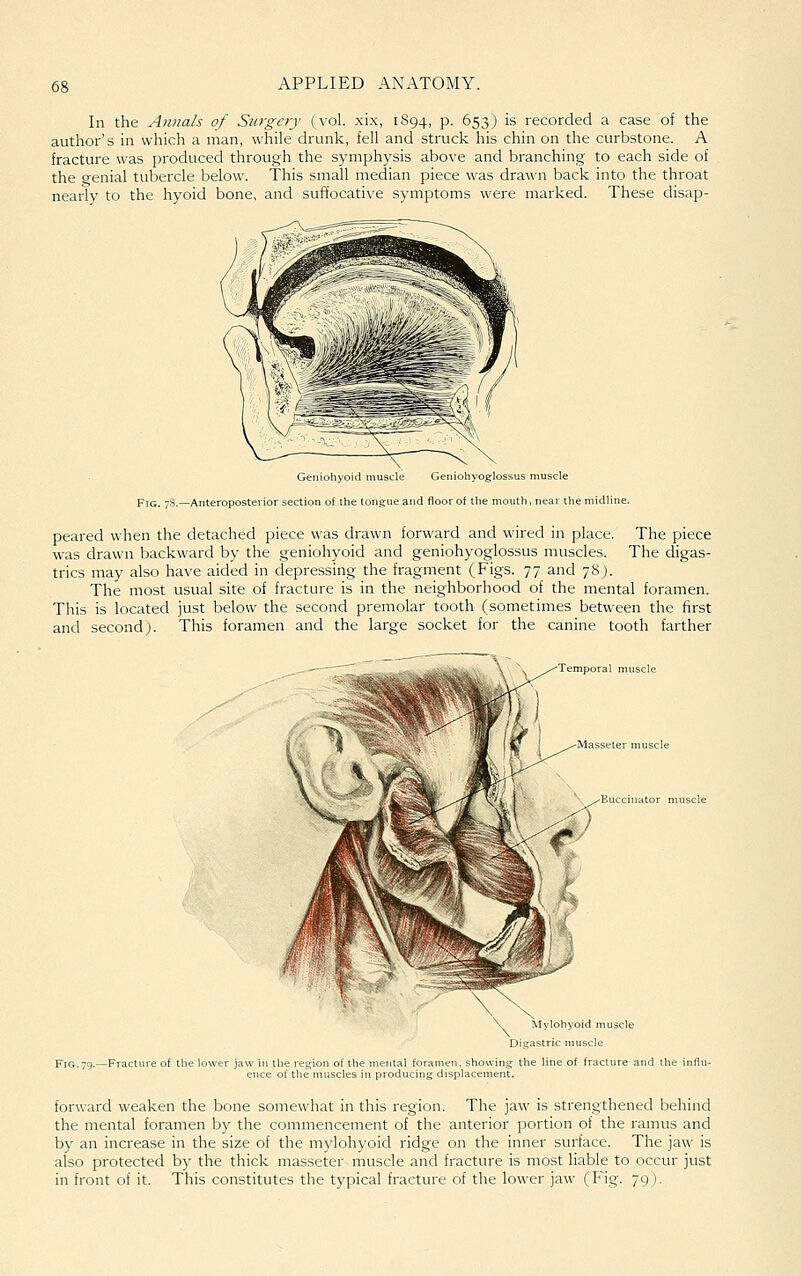 In the Ajinah of Surgery (vol. xi.x, 1894, p. 653) is recorded a case of the author's in which a man, while drunk, fell and struck his chin on the curbstone. A fracture was produced through the symphysis above and branching to each side of the crenial tubercle below. This small median piece was drawn back into the throat nearly to the hyoid bone, and suffocative symptoms were marked. These disap- Geniohyoid muscle Geniohyoglossus muscle Fig. 7S.—Anteroposterior section of the tongue and floor of the mouth, near the midline. peared when the detached piece was drawn forward and wired in place. The piece was drawn backward by the geniohyoid and geniohyoglossus muscles. The digas- trics may also have aided in depressing the fragment (Figs. 77 and 78). The most usual site of fracture is in the neighborhood of the mental foramen. This is located just below the second premolar tooth (sometimes between the first and second J. This foramen and the large socket for the canine tooth farther Masseter muscle Buccinator muscle Fig. 79.—Fracture of the lower ja on of the mental foramen, showing the lii nuscles in producing displacement. forward weaken the bone somewhat in this region. The jaw is strengthened behind the mental foramen by the commencement of the anterior portion of the ramus and by an increase in the size of the mylohyoid ridge on the inner surface. The jaw is also protected by the thick masseter muscle and fracture is most liable to occur just in front of it. This constitutes the typical fracture of the lower jaw (Fig. 79 ).