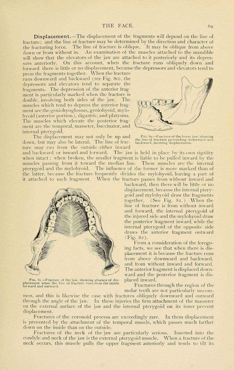 Fig. So.—Fracture of the lower jaw, s the line of fracture proceeding downwj backward, favoring displacement. Displacement.—The displacement of the fragments will depend on the line of fracture; and the line of fracture may be determined by the direction and character of the fracturing force. The line of fracture is oblique. It may be oblique from above down or from without in. An examination of the muscles attached to the mandible will show that the elevators of the jaw are attached to it posteriorly and its depres- sors anteriorly. On this account, when the fracture runs obliquely down and forward there is little or no displacement, because the depressors and elevators tend to press the fragments together. When the fracture runs downward and backward (see Fig. 80), the depressors and elevators tend to separate the fragments. The depression of the anterior frag- ment is particularly marked when the fracture is double, involving both sides of the jaw. The muscles which tend to depress the anterior frag- ment are the geniohyoglossus, geniohyoid, mylo- hyoid (anterior portion ), digastric, and platysma. The muscles which elevate the posterior frag- ment are the temporal, masseter, buccinator, and internal pterygoid. The displacement may not only be up and down, but may also be lateral. The line of frac- ture may run from the outside either inward and backward or inward and forward. The jaw is held in place by its own rigidity when intact; when broken, the smaller fragment is liable to be pulled inward by the muscles passing from it toward the median line. These muscles are the internal pterygoid and the mylohyoid. The influence of the former is more marked than of the latter, because the fracture frequently divides the mylohyoid, leaving a part of it attached to each fragment. When the fracture passes from without inward and backward, then there will be little or no displacement, because the internal pteiy- goid and mylohyoid draw the fragments together. (See Fig. 81.) When the line of fracture is from without inward and forward, the internal pterygoid of the injured side and the mylohyoid draw the posterior fragment inward, while the internal pterygoid of the opposite side draws the anterior fragment outward (Fig. 82). From a consideration of the forego- ing facts, we see that when there is dis- placement it is because the fracture runs from above downward and backward, and from without inward and forward. The anterior fragment is displaced down- ward and the posterior fragment is dis- placed inward. Fractures through the region of the molar teeth are not particularly uncom- mon, and this is likewise the case with fractures obliquely downward and outward through the angle of the jaw. In these injuries the firm attachment of the masseter on the external surface of the jaw and the internal pterygoid on its inner prevent displacement. Fractures of the coronoid process are exceedingly rare. In them displacement is prevented by the attachment of the temporal muscle, which passes much farther down on the inside than on the outside. Fractures of the neck of the jaw are particularly serious. Inserted into the condyle and neck of the jaw is the external pterygoid muscle. When a fracture of the neck occurs, this muscle pulls the upper fragment anteriorly and tends to tilt its Fig. 81.—Fracture of the jaw, showing absence of d placement when the line of fracture runs fiom the msi forward and outward.