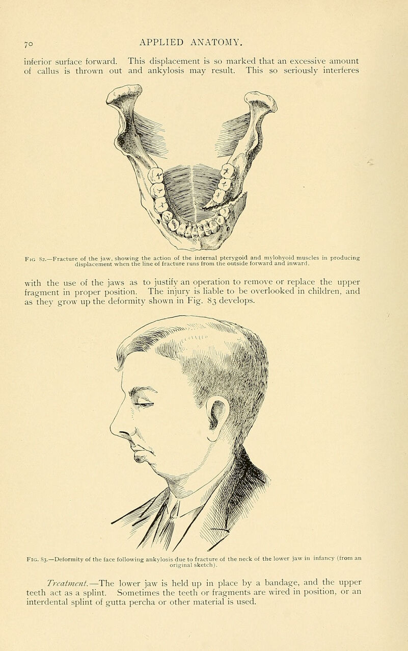 7° inferior surface forward. This displacement is so marked that an excessi\'e amount of caUus is thrown out and ankylosis may result. This so seriously interferes Fig 82.—Fracture of the jaw, showing the action of the internal pterygoid and mj'lohyoid muscle displacement when the line of fracture runs from the outside forward and inward. produ with the use of the jaws as to justify an operation to remove or replace the upper frao-ment in proper position. The injury is liable to be overlooked in children, and as they grow up the deformity shown in Fig. 83 de\'elops. Fig. 83.—Deformity of the face following ankylosis due to fracture of the neck of the lower jaw in infancy (from an original sketch). Treatment.—The lower jaw is held up in place by a bandage, and the upper teeth act as a splint. Sometimes the teeth or fragments are wired in position, or an interdental splint of gutta percha or other material is used.