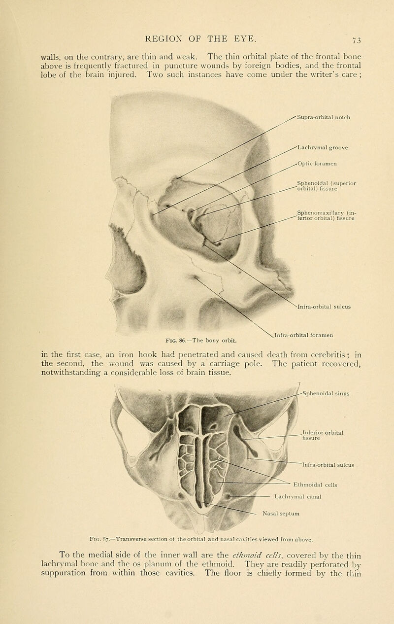 walls, on the contrary, are thin and weak. The thin orbital plate of the frontal bone above is frequently fractured in puncture wounds by foreign bodies, and the frontal lobe of the brain injured. Two such instances have come under the writer's care; Supra-orbital notch Lachr\mal groove Optic foramen Infra-orbital sulcus The bony orbit. Infra-orbital foran in the first case, an iron hook had penetrated and caused death from cerebritis ; in the second, the wound was caused by a carriage pole. The patient recovered, notwithstanding a considerable loss of brain tissue. Ethmoidal cells Lachrymal canal Fig. S7.—Transverse section of the orbital and nasal cavities viewed from above. To the medial side of the inner wall are the ethmoid cells, covered by the thin lachrymal bone and the os planum of the ethmoid. They are readily perforated by suppuration from within those cavities. The floor is chiefly formed by the thin