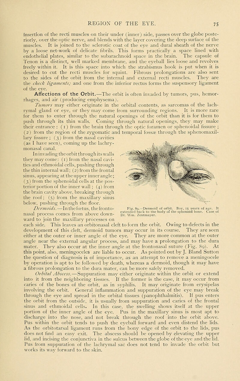 ^<'*-',—-rf^ insertion of the recti muscles on their under (inner) side, passes over the globe poste- riorly, over the optic nerve, and blends with the layer covering the deep surface of the muscles. It is joined to the sclerotic coat of the eye and dural sheath of the nerve by a loose net-work of delicate fibrils. This forms practically a space lined with endothelial plates, similar to the subarachnoid space in the brain. The capsule of Tenon is a distinct, well marked membrane, and the eyeball lies loose and revolves freely within it. It is this space into which the strabismus hook is put when it is desired to cut the recti muscles for squint. Fibrous prolongations are also sent to the sides of the orbit from the internal and external recti muscles. They are the check ligaments; and one from the inferior rectus forms the suspensory ligament of the eye. Affections of the Orbit.—The orbit is often invaded by tumors, pus, hemor- rhages, and air (producing emphysema). Tumors may either originate in the orbital contents, as sarcomas of the lach- rymal gland or eye, or they may come from surrounding regions. It is more rare for them to enter through the natural openings of the orbit than it is for them to push through its thin walls. Coming through natural openings, they may make their entrance : (i) from the brain through the optic foramen or sphenoidal fissure ; (2) from the region of the zygomatic and temporal fossae through the sphenomaxil- lary fissure ; (3) from the nasal cavities (as I have seen), coming up the lachry- monasal canal. In invading the orbit through its walls they may come: (i) from the nasal cavi- ties and ethmoidal cells, pushing through the thin internal wall; (2) from the frontal sinus, appearing at the upper inner angle; (3) from the sphenoidal cells at the pos- terior portion of the inner wall; (4) from the brain cavity above, breaking through the roof; (5) from the maxillary sinus below, pushing through the floor. Dermoids.—In thefoetus, the fronto- nasal process comes from above down- ward to join the maxillary processes on each side. This leaves an orbitonasal cleft to form the orbit. Owing to defects in the development of this cleft, dermoid tumors may occur in its course. They are seen either at the outer or inner angle of the eye. They are more common at the outer angle near the e.xternal angular process, and may have a prolongation to the dura mater. They also occur at the inner angle at the frontonasal suture (Fig. 89). At this point, also, meningoceles are liable to occur. As pointed out by J. Bland Sutton the question of diagnosis is of importance, as an attempt to remove a meningocele by operation is apt to be followed by death, whereas a dermoid, though it may have a fibrous prolongation to the dura mater, can be more safely removed. Orbital Abscess.—Suppuration. may either originate within the orbit or extend into it from the neighboring tissues. If the former is the case, it may occur from caries of the bones of the orbit, as in syphilis. It may originate from erysipelas involving the orbit. General inflammation and suppuration of the eye may break through the eye and spread in the orbital tissues (panophthalmitis). If pus enters the orbit from the outside, it is usually from suppuration and caries of the frontal sinus and ethmoidal cells. In this case, the swelling shows itself at the upper portion of the inner angle of the eye. Pus in the maxillary sinus is most apt to discharge into the nose, and not break through the roof into the orbit above. Pus within the orbit tends to push the eyeball forward and even distend the lids. As the orbitotarsal ligament runs from the bony edge of the orbit to the lids, pus does not find an easy exit. The abscess should be opened by elevating the upper lid, and incising the coniuncti\'a in the sulcus between the globe of the eye and the lid. Pus from suppuration of the lachrymal sac does not tend to in\-ade the orbit but works its way forward to the skin. Fi^. 89.—Dermoid of orbit. Boy, 15 years of age. It extended back to the body of the sphenoid bone. Case of Dr. Wm. Zentmayer.