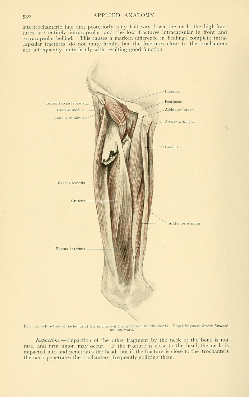 53° intertrochanteric line and posteriorly only half way down the neck, the high frac- tures are entirely intracapsular and the low fractures intracapsular in front and extracapsular behind. This causes a marked difference in healing; complete intra- capsular fractures do not unite firmly, but the fractures close to the trochanters not infrequently unite firmly with resulting good function. Tensor fascite femorii Gluteus med: Rectus femoris Adductor magnus Vastus interaus Fig. 540.—Fractu of the femur at the junctu liddle thirds. Upper fragment dr. Impaction.—Impaction of the other fragment by the neck of the bone is not rare, and firm union may occur. If the fracture is close to the head, the neck is impacted into and penetrates the head, but if the fracture is close to the trochanters the neck penetrates the trochanters, frequently splitting them.
