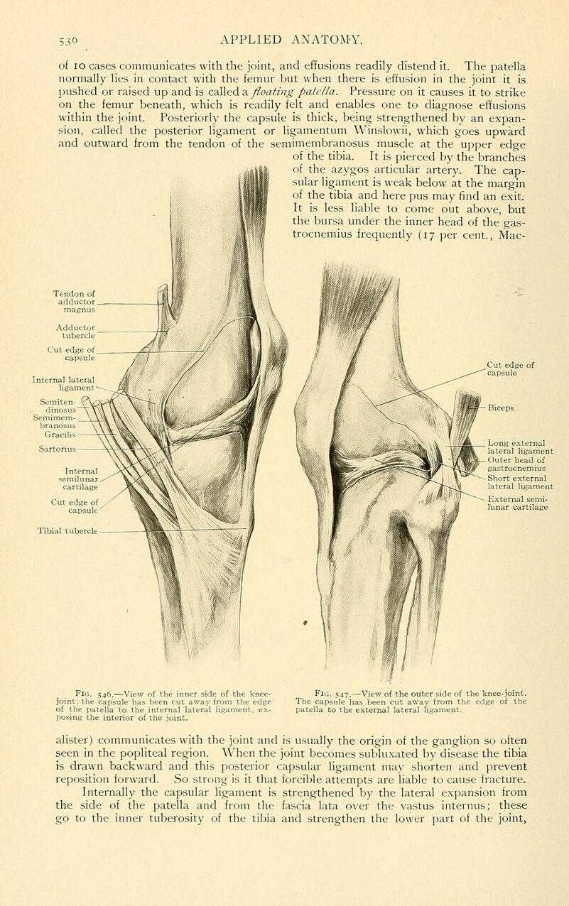 of lo cases communicates with the joint, and effusions readily distend it. The patella normally lies in contact with the femur but when there is effusion in the joint it is pushed or raised up and is calleda. floatingpateHa. Pressure on it causes it to strike on the femur beneath, which is readily felt and enables one to diagnose effusions within the joint. Posteriorly the capsule is thick, being strengthened by an expan- sion, called the posterior ligament or ligamentum Winslowii, which goes upward and outward from the tendon of the semimembranosus muscle at the upper edge of the tibia. It is pierced by the branches of the azygos articular artery. The cap- sular ligament is weak below at the margin of the tibia and here pus may find an exit. It is less liable to come out above, but the bursa under the inner head of the gas- trocnemius frequently (17 per cent., Mac- Tendon of adductor magnus Tibial tubercle Long external lateral ligament Outer head of gastrocnemius Short external lateral ligament Fig. 546.—View of the inner side of the knee- joint; the capsule has been cut away from the edge of the patella to the internal lateral ligament, ex- posing the interior of the joint. Fig. 547.—View of the outer side of the knee-joint. The capsule has been cut away from the edge of the patella to the external lateral ligament. alister) communicates with the joint and is usually the origin of the ganglion so often seen in the popliteal region. When the joint becomes subluxated by disease the tibia is drawn backward and this posterior capsular ligament may shorten and prevent reposition forward. So strong is it that forcible attempts are liable to cause fracture. Internally the capsular ligament is strengthened by the lateral expansion from the side of the patella and from the fascia lata over the vastus internus; these go to the inner tuberosity of the tibia and strengthen the lower part of the joint,