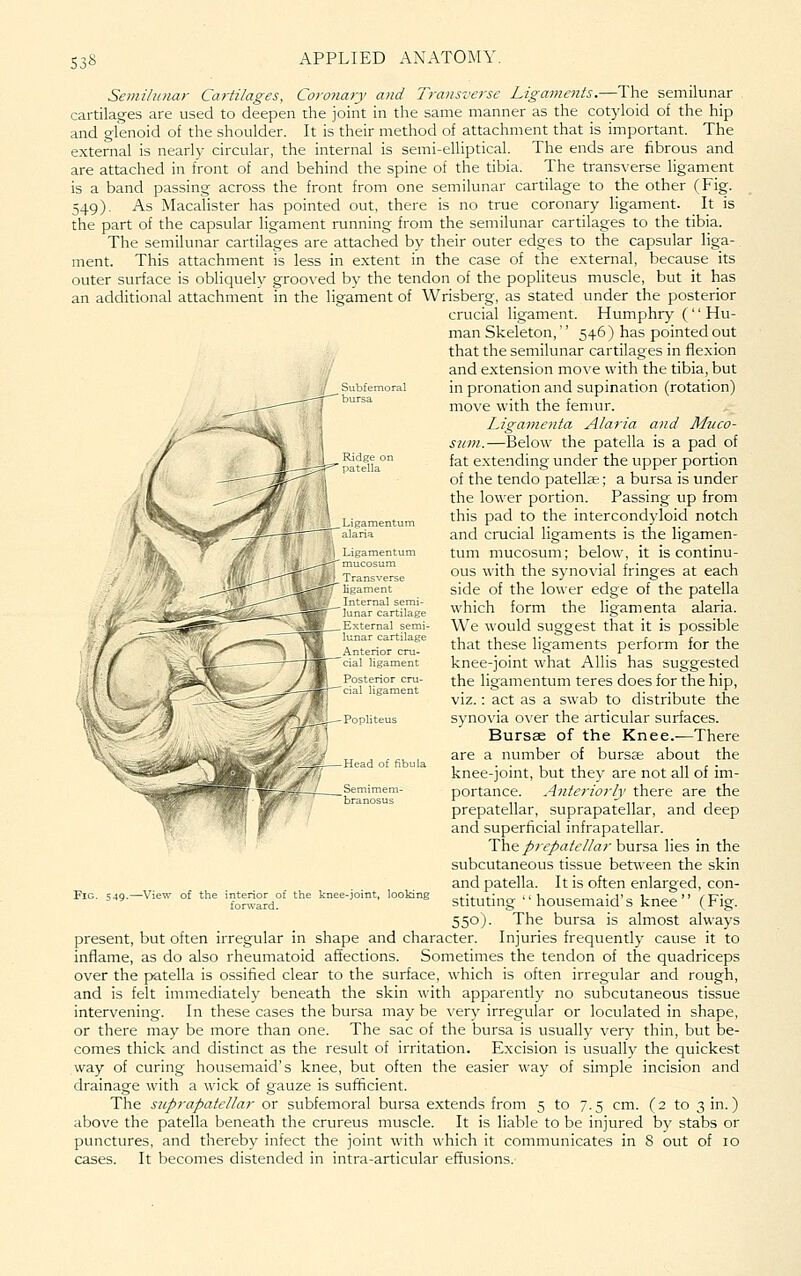 Semilunar Cartilages, Coronary and Transverse Ligaments.—The semilunar cartilages are used to deepen the joint in the same manner as the cotyloid of the hip and glenoid of the shoulder. It is their method of attachment that is important. The external is nearh' circular, the internal is semi-elliptical. The ends are fibrous and are attached in front of and behind the spine of the tibia. The transverse ligament is a band passing across the front from one semilunar cartilage to the other (Fig. 549). As Macalister has pointed out, there is no true coronary ligament. It is the part of the capsular ligament running from the semilunar cartilages to the tibia. The semilunar cartilages are attached by their outer edges to the capsular liga-. ment. This attachment is less in extent in the case of the external, because its outer surface is obliquely grooved by the tendon of the popliteus muscle, but it has an additional attachment in the ligament of Wrisberg, as stated under the posterior crucial ligament. Humphry ('' Hu- man Skeleton,'' 546) has pointed out that the semilunar cartilages in flexion and extension move with the tibia, but in pronation and supination (rotation) move with the femur. Ligamenta Alaria and Muco- sum.—Below the patella is a pad of fat extending under the upper portion of the tendo patellae; a bursa is under the lower portion. Passing up from this pad to the intercondyloid notch and crucial ligaments is the ligamen- tum mucosum; below, it is continu- ous with the synovial fringes at each side of the lower edge of the patella which form the ligamenta alaria. We would suggest that it is possible that these ligaments perform for the knee-joint what Allis has suggested the ligamentum teres does for the hip, viz.: act as a swab to distribute the synovia over the articular surfaces. Bursae of the Knee.—There ,, J ^^ , are a number of bursae about the Head or nbula , . . , , ,, - . knee-jomt, but they are not all 01 im- Semimem- portance. Anteriorly there are the branosus ^ ,, -^ ,, , , prepatellar, suprapatellar, and deep and superficial infrapatellar. 'Y\iQ prepatellarh\xr?,2L lies in the subcutaneous tissue between the skin and patella. It is often enlarged, con- stituting housemaid's knee (Fig. 550). The bursa is almost always present, but often irregular in shape and character. Injuries frequently cause it to inflame, as do also rheumatoid affections. Sometimes the tendon of the quadriceps over the patella is ossified clear to the surface, which is often irregular and rough, and is felt immediately beneath the skin with apparently no subcutaneous tissue intervening. In these cases the bursa may be very irregular or loculated in shape, or there may be more than one. The sac of the bursa is usually very thin, but be- comes thick and distinct as the result of irritation. Excision is usually the quickest way of curing housemaid's knee, but often the easier way of simple incision and drainage with a wick of gauze is sufficient. The suprapatellar or subfemoral bursa extends from 5 to 7.5 cm. (2 to 3 in.) above the patella beneath the crureus muscle. It is liable to be injured by stabs or punctures, and thereby infect the joint with which it communicates in 8 out of 10 cases. It becomes distended in intra-articular effusions. h^ tment In ernal semi- I in ir cartilage L ernal semi- K n^r cartilage \ntenor cru- cial ligament Postenor cru- cial ligament Popliteus