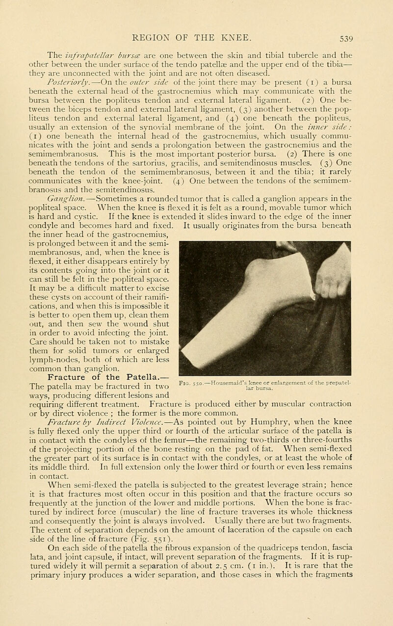 The infrapatellar bursce are one between the skin and tibial tubercle and the other between the under surface of the tendo patellae and the upper end of the tibia— they are unconnected with the joint and are not often diseased. Posteriorly.—On the outer side of the joint there may be present (i) a bursa beneath the external head of the gastrocnemius which may communicate with the bursa between the popliteus tendon and external lateral ligament. (2) One be- tween the biceps tendon and external lateral ligament, (3) another between the pop- liteus tendon and external lateral ligament, and (4) one beneath the popliteus, usually an extension of the synovial membrane of the joint. On the inner side: (i) one beneath the internal head of the gastrocnemius, which usually commu- nicates with the joint and sends a prolongation between the gastrocnemius and the semimembranosus. This is the most important posterior bursa. (2) There is one beneath the tendons of the sartorius, gracilis, and semitendinosus muscles. (3) One beneath the tendon of the semimembranosus, between it and the tibia; it rarely communicates with the knee-joint. (4) One between the tendons of the semimem- branosus and the semitendinosus. Ganglion.—Sometimes a rounded tumor that is called a ganglion appears in the popliteal space. When the knee is flexed it is felt as a round, movable tumor which is hard and cystic. If the knee is extended it slides inward to the edge of the inner condyle and becomes hard and fixed. It usually originates from the bursa beneath the inner head of the gastrocnemius, is prolonged between it and the semi- membranosus, and, when the knee is flexed, it either disappears entirely by its contents going into the joint or it can still be felt in the popliteal space. It may be a difficult matter to excise these cysts on account of their ramifi- cations, and when this is impossible it is better to open them up, clean them out, and then sew the wound shut in order to avoid infecting the joint. Care should be taken not to mistake them for solid tumors or enlarged lymph-nodes, both of which are less common than ganglion. Fracture of the Patella.— The patella may be fractured in two ways, producing different lesions and requiring different treatment. Fracture is produced either by muscular contraction or by direct violence ; the former is the more common. Fracture by Indirect Violence.—As pointed out by Humphry, when the knee is fully flexed only the upper third or fourth of the articular surface of the patella is in contact with the condyles of the femur—the remaining two-thirds or three-fourths of the projecting portion of the bone resting on the pad of fat. When semi-flexed the greater part of its surface is in contact with the condyles, or at least the w'hole of its middle third. In full extension only the lower third or fourth or even less remains in contact. When semi-flexed the patella is subjected to the greatest leverage strain; hence it is that fractures most often occur in this position and that the fracture occurs so frequently at the junction of the lower and middle portions. When the bone is frac- tured by indirect force (muscular) the line of fracture traverses its whole thickness and consequently the joint is always involved. Usually there are but two fragments. The extent of separation depends on the amount of laceration of the capsule on each side of the line of fracture (Fig. 551). On each side of the patella the fibrous expansion of the quadriceps tendon, fascia lata, and joint capsule, if intact, will prevent separation of the fragments. If it is rup- tured widely it will permit a separation of about 2.5 cm. (i in.). It is rare that the primary injury produces a wider separation, and those cases in which the fragments