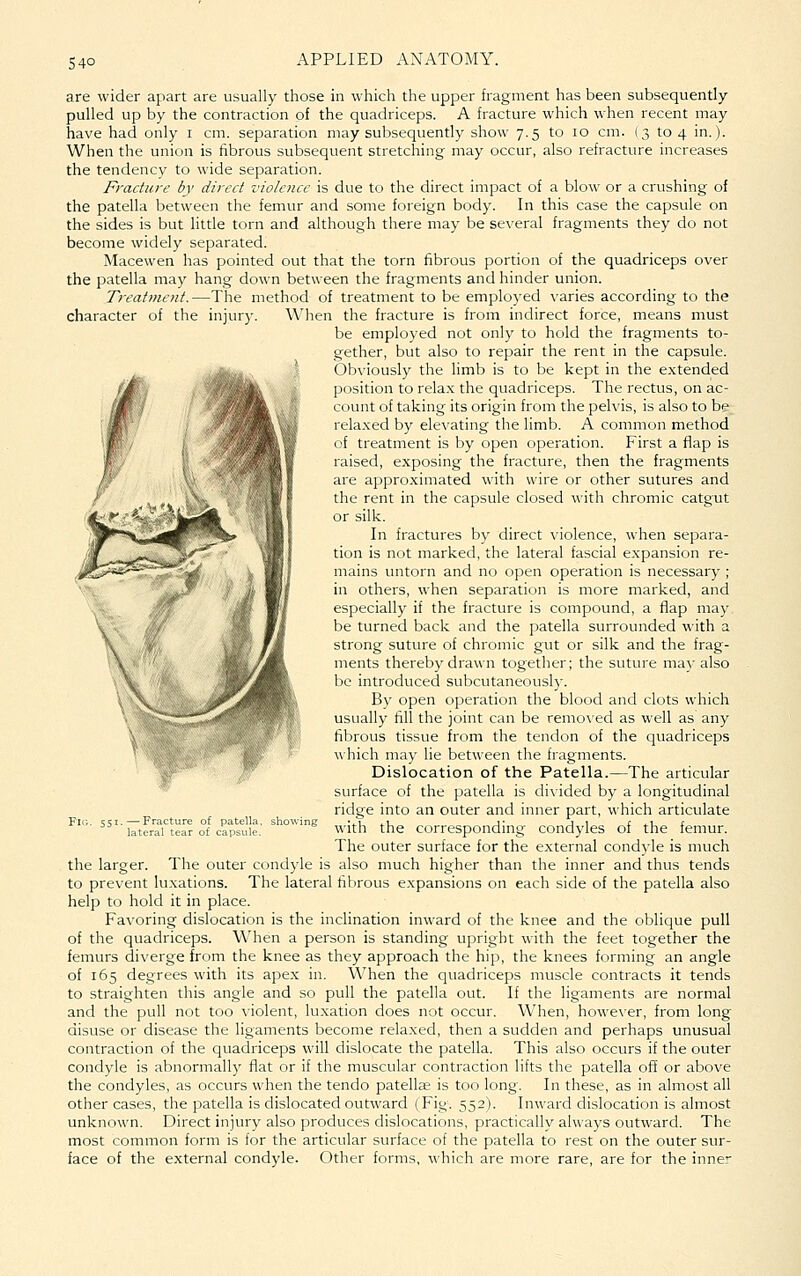 S40 are wider apart are usually those in which the upper fragment has been subsequently- pulled up by the contraction of the quadriceps. A fracture which when recent may have had only i cm. separation may subsequently show 7.5 to 10 cm. (3 to 4 in.). When the union is fibrous subsequent stretching may occur, also refracture increases the tendency to wide separation. Fracture by direct violence is due to the direct impact of a blow or a crushing of the patella between the femur and some foreign body. In this case the capsule on the sides is but little torn and although there may be several fragments they do not become widely separated. Macewen has pointed out that the torn fibrous portion of the quadriceps over the patella may hang down between the fragments and hinder union. Treatment.—The method of treatment to be employed varies according to the character of the injury. When the fracture is from indirect force, means must be employed not only to hold the fragments to- gether, but also to repair the rent in the capsule. Obviously the limb is to be kept in the extended position to relax the quadriceps. The rectus, on ac- count of taking its origin from the pelvis, is also to be relaxed by elevating the limb. A common method of treatment is by open operation. First a flap is raised, exposing the fracture, then the fragments are approximated with wire or other sutures and the rent in the capsule closed with chromic catgut or silk. In fractures by direct violence, when separa- tion is not marked, the lateral fascial expansion re- mains untorn and no open operation is necessary ; in others, when separation is more marked, and especially if the fracture is compound, a flap may be turned back and the patella surrounded with a strong suture of chromic gut or silk and the frag- ments thereby drawn together; the suture may also be introduced subcutaneousl)-. By open operation the blood and clots which usually fill the joint can be removed as well as any fibrous tissue from the tendon of the quadriceps «hich may lie between the fragments. Dislocation of the Patella.—The articular surface of the patella is divided by a longitudinal ridge into an outer and inner part, which articulate with the corresponding condyles of the femur. The outer surface for the external condyle is much the larger. The outer condj-le is also much higher than the inner and thus tends to prevent luxations. The lateral fibrous expansions on each side of the patella also help to hold it in place. Favoring dislocation is the inclination inward of the knee and the oblique pull of the quadriceps. When a person is standing upright with the feet together the femurs diverge from the knee as they approach the hip, the knees forming an angle of 165 degrees with its apex in. When the quadriceps muscle contracts it tends to straighten this angle and so pull the patella out. If the ligaments are normal and the pull not too violent, luxation does not occur. When, however, from long disuse or disease the ligaments become relaxed, then a sudden and perhaps unusual contraction of the quadriceps will dislocate the patella. This also occurs if the outer condyle is abnormall)' flat or if the muscular contraction lifts the patella off or above the condyles, as occurs when the tendo patellae is too long. In these, as in almost all other cases, the patella is dislocated outward (Fig. 552). Inward dislocation is almost unknown. Direct injury also produces dislocations, practically always outward. The most common form is for the articular surface of the patella to rest on the outer sur- face of the external condyle. Other forms, which are more rare, are for the inner vt'
