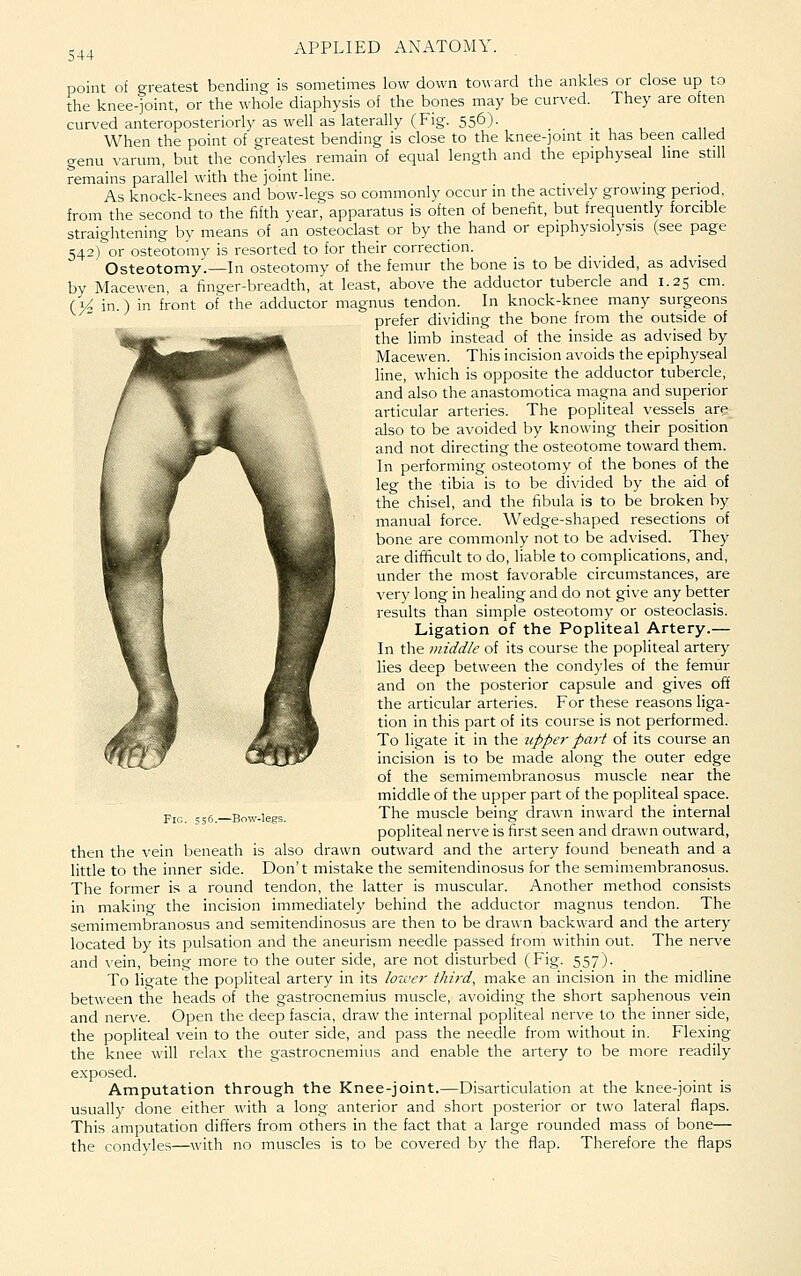 point of greatest bending is sometimes low down toward the ankles or close up to the knee-joint, or the whole diaphysis of the bones may be curved. They are often curved anteroposteriorly as well as laterally (Fig. 556). . , , When the point of greatest bending is close to the knee-jomt it has been called genu varum, but the condyles remain of equal length and the epiphyseal Ime still remains parallel with the joint line. As knock-knees and bow-legs so commonly occur m the actively growing period, from the second to the f^fth year, apparatus is often of benefit, but frequently forcible straightening by means of an osteoclast or by the hand or epiphysiolysis (see page 542) or osteotomy is resorted to for their correction. , . , Osteotomy.—In osteotomy of the femur the bone is to be divided, as advised by Macewen, a finger-breadth, at least, above the adductor tubercle and 1.25 cm. (>4 in.) in front of the adductor magnus tendon. In knock-knee many surgeons prefer dividing the bone from the outside of the limb instead of the inside as advised by Macewen. This incision avoids the epiphyseal line, which is opposite the adductor tubercle, and also the anastomotica magna and superior articular arteries. The popliteal vessels are also to be avoided by knowing their position and not directing the osteotome toward them. In performing osteotomy of the bones of the leg the tibia is to be divided by the aid of the chisel, and the fibula is to be broken by manual force. Wedge-shaped resections of bone are commonly not to be advised. They are difficult to do, liable to complications, and, under the most favorable circumstances, are very long in healing and do not give any better results than simple osteotomy or osteoclasis. Ligation of the Popliteal Artery.— In the middle of its course the popliteal artery lies deep between the condyles of the femur and on the posterior capsule and gives off the articular arteries. For these reasons liga- tion in this part of its course is not performed. To ligate it in the upper part of its course an incision is to be made along the outer edge of the semimembranosus muscle near the middle of the upper part of the popliteal space. The muscle being drawn inward the internal popliteal nerve is first seen and drawn outward, then the vein beneath is also drawn outward and the artery found beneath and a little to the inner side. Don't mistake the semitendinosus for the semimembranosus. The former is a round tendon, the latter is muscular. Another method consists in making the incision immediately behind the adductor magnus tendon. The semimembranosus and semitendinosus are then to be drawn backward and the artery located by its pulsation and the aneurism needle passed from within out. The nerve and vein, being more to the outer side, are not disturbed (Fig. 557). To ligate the popliteal artery in its lower third, make an incision in the midline between the heads of the gastrocnemius muscle, avoiding the short saphenous vein and nerve. Open the deep fascia, draw the internal popliteal nerve to the inner side, the popliteal vein to the outer side, and pass the needle from without in. Flexing the knee will relax the gastrocnemius and enable the artery to be more readily exposed. Amputation through the Knee-joint.—Disarticulation at the knee-joint is usually done either with a long anterior and short posterior or two lateral flaps. This amputation differs from others in the fact that a large rounded mass of bone— the condyles—with no muscles is to be covered by the flap. Therefore the flaps Fig. ss6.—Bnw-legs.