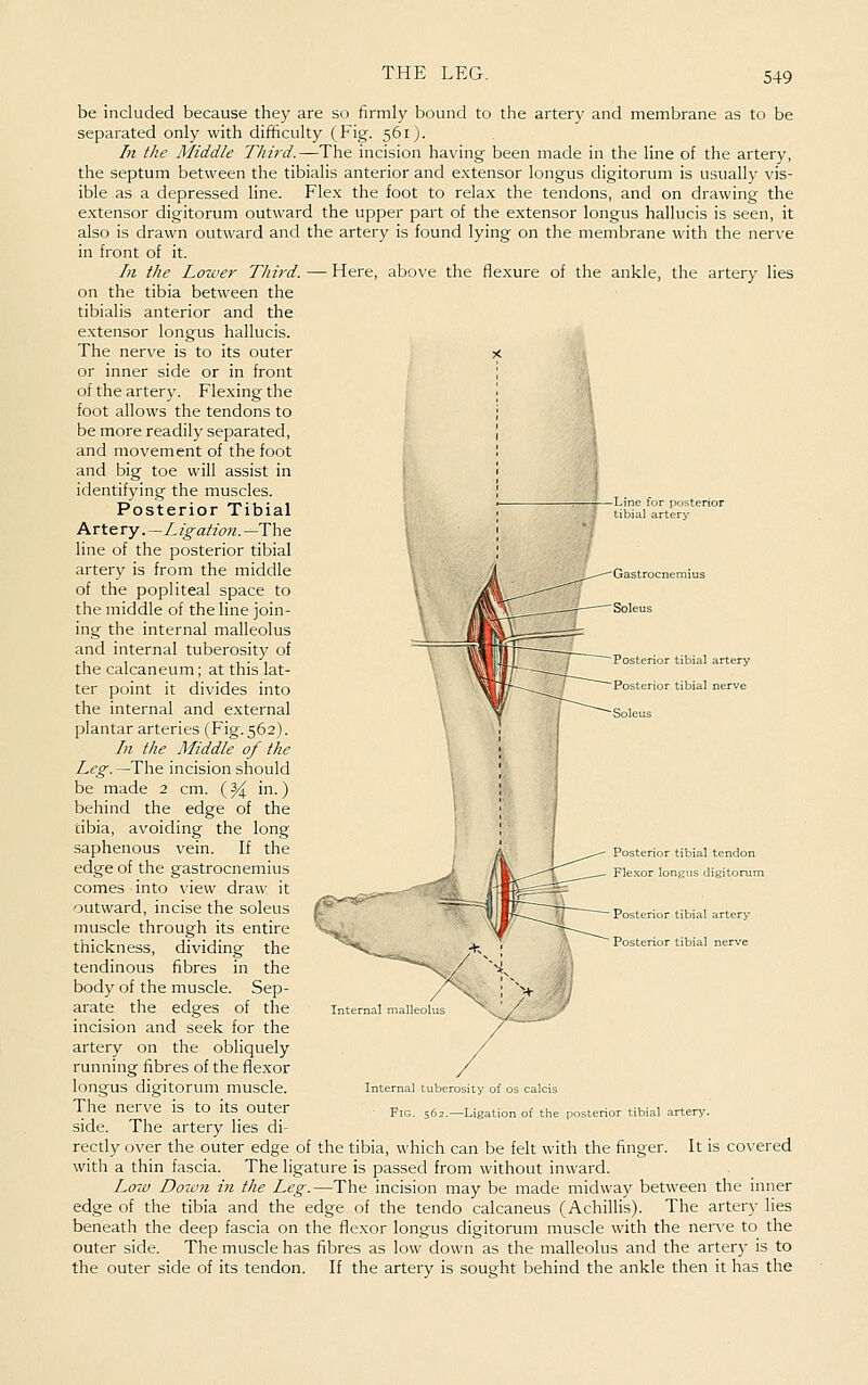 Gastrocnemius be included because they are so firmly bound to the artery and membrane as to be separated only with difficulty (Fig. 561 j. hi the Middle Third.—The incision having been made in the line of the artery, the septum between the tibialis anterior and extensor longus digitorum is usually vis- ible as a depressed line. Flex the foot to relax the tendons, and on drawing the extensor digitorum outward the upper part of the extensor longus hallucis is seen, it also is drawn outward and the artery is found lying on the membrane with the nerve in front of it. In the Lower Third. — Here, above the flexure of the ankle, the artery lies on the tibia between the tibialis anterior and the extensor longus hallucis. The nerve is to its outer or inner side or in front of the artery. Flexing the foot allows the tendons to be more readily separated, and movement of the foot and big toe will assist in identifying the muscles. Posterior Tibial Krt^Yy .—Ligation.—T\i& line of the posterior tibial artery is from the middle of the popliteal space to the middle of the line join- ing the internal malleolus and internal tuberosity of the calcaneum; at this lat- ter point it divides into the internal and external plantar arteries (Fig. 562). hi the Middle of the Leg. —The incision should be made 2 cm. (% in.) behind the edge of the dbia, avoiding the long saphenous vein. If the edge of the gastrocnemius comes into view draw it outward, incise the soleus muscle through its entire thickness, dividing the tendinous fibres in the body of the muscle. Sep- arate the edges of the incision and seek for the artery on the obliquely running fibres of the flexor longus digitorum muscle. The nerve is to its outer side. The artery lies di- rectly over the outer edge of the tibia, which can be felt with the finger. It is covered with a thin fascia. The ligature is passed from without inward. Low Dow7i in the Leg.—The incision may be made midway between the inner edge of the tibia and the edge of the tendo calcaneus (Achillis). The artery lies beneath the deep fascia on the flexor longus digitorum muscle with the nerve to the outer side. The muscle has fibres as low down as the malleolus and the artery is to the outer side of its tendon. If the artery is sought behind the ankle then it has the Posterior tibial tendon Flexor longus digitorum Posterior tibial artery Posterior tibial nerve Internal tuberosity of os calcis Fig. 562.—Ligation of the posterior tibial artery.