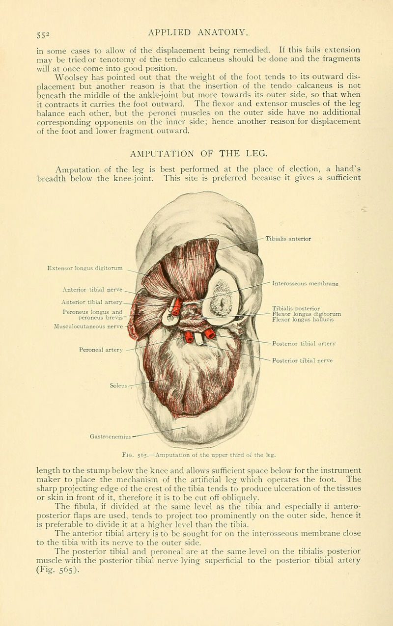 in some cases to allow of the displacement being remedied. If this fails extension may be tried or tenotomy of the tendo calcaneus should be done and the fragments will at once come into good position. Woolsey has pointed out that the weight of the foot tends to its outward dis- placement but another reason is that the insertion of the tendo calcaneus is not beneath the middle of the ankle-joint but more towards its outer side, so that when it contracts it carries the foot outward. The flexor and extensor muscles of the leg balance each other, but the peronei muscles on the outer side have no additional corresponding opponents on the inner side; hence another reason for displacement of the foot and lower fragment outward. A^IPUTATION OF THE LEG. Amputation of the leg is best performed at the place of election, a hand's breadth below the knee-joint. This site is preferred because it gives a sufficient Extensor longus digitonmi Anterior tibial ner\ .Anterior tibial artf r Musculocutaneous -' Tibialis anterior postenor ongus digitorul Flexor longus hallucis Posterior tibial artery Posterior tibial nerve 5-—.\mputation of the upper third of the leg. length to the stump below the knee and allows sufficient space below for the instrument maker to place the mechanism of the artificial leg which operates the foot. The sharp projecting edge of the crest of the tibia tends to produce ulceration of the tissues or siiin in front of it, therefore it is to be cut off obliquely. The fibula, if di\'ided at the same level as the tibia and especially if antero- posterior flaps are used, tends to project too prominently on the outer side, hence it is preferable to divide it at a higher level than the tibia. The anterior tibial artery is to be sought for on the interosseous membrane close to the tibia with its nerve to the outer side. The posterior tibial and peroneal are at the same level on the tibialis posterior muscle with the posterior tibial nerve Iving superficial to the posterior tibial artery (Fig. 565).