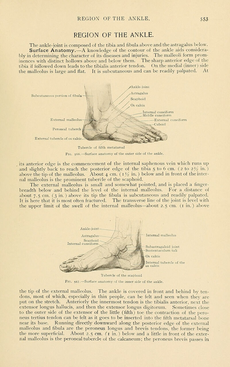 REGION OF THE ANKLE. The ankle-joint is composed of the tibia and fibula above and the astragalus below. Surface Anatomy.—A knowledge of the contour of the ankle aids considera- bly in determining the character of its diseases and injuries. The malleoli form prom- inences with distinct hollows above and below them. The sharp anterior edge of the tibia if followed down leads to the tibialis anterior tendon. On.the medial (inner) side the malleolus is large and flat. It is subcutaneous and can be readily palpated. At Subcutaneous portion of fibula —r External malleolus Peroneal tubercle External tubercle of os Calais Tubercle of fifth metatarsal Fig. s66,—Surface anatomy of the outer side of the ankle. its anterior edge is the commencement of the internal saphenous vein which runs up and slightly back to reach the posterior edge of the tibia 5 to 6 cm. (2 to 2>^ in.) above the tip of the malleolus. About 4 cm. (i}4 in. ) below and in front of the inter- nal malleolus is the prominent tubercle of the scaphoid. The external malleolus is small and somewhat pointed, and is placed a finger- breadth below and behind the level of the internal malleolus. For a distance of about 7.5 cm. (3 in. ) above its tip the fibula is subcutaneous and readily palpated. It is here that it is most often fractured. The transverse line of the joint is level with the upper limit of the swell of the internal malleolus—about 2.5 cm. (i in.) above Internal malleolus Subastragaloid joint Sustentaculum tali Tubercle of the scaphoid Fig. 567.—Surface anatomy of the inner side of the ankle. the tip of the external malleolus. The ankle is covered in front and behind by ten- dons, most of which, especially in thin people, can be felt and seen when the)- are put on the stretch. Anteriorly the innermost tendon is the tibialis anterior, next the extensor longus hallucis, and then the e.xtensor longus digitorum. Sometimes close to the outer side of the extensor of the little (fifth) toe the contraction of the pero- neus tertius tendon can be felt as it goes to be inserted into the fifth metatarsal bone near its base. Running directly downward along the posterior edge of the external malleolus and fibula are the peroneus longus and brevis tendons, the former being the more superficial. About 2.5 cm. (i in.) below and a little in front of the exter- nal malleolus is the peroneal tubercl? of the calcaneum; the peroneus brevis passes in