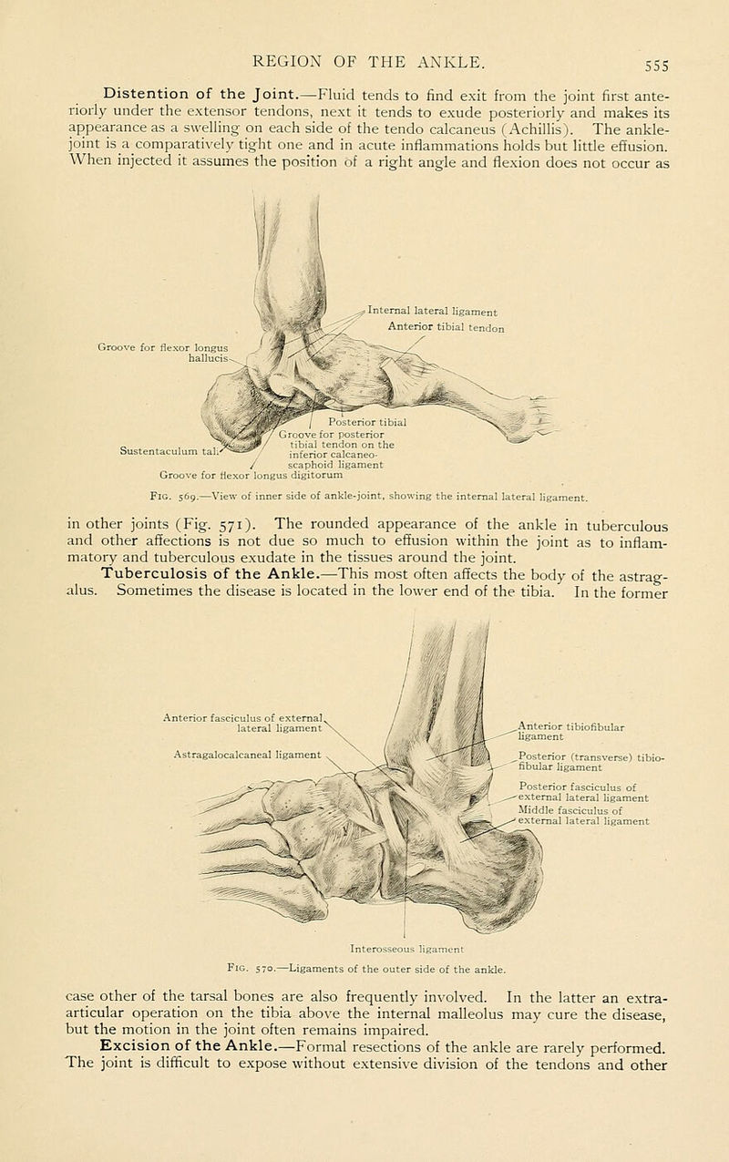 SS5 Distention of the Joint.—Fluid tends to find exit from the joint first ante- riorly under the extensor tendons, next it tends to exude posteriorly and makes its appearance as a swelling on each side of the tendo calcaneus (Achillis). The ankle- joint isacomparatively tight one and in acute inflammations holds but litde effusion. When injected it assumes the position of a right angle and flexion does not occur as Sustentaculum taL'^^'^i*^ / Groove for fiexor longi: Fig. 569.—View of innei «Internal lateral ligament Anterior tibial tendon / Posterior tibial I ove tor postenor tibial tendon on the ^^ infenor calcaneo- scaphoid ligament ; digitorum side of ankle-joint, showing the internal lateral ligament. in other joints (Fig. 571). The rounded appearance of the ankle in tuberculous and other affections is not due so much to effusion within the joint as to inflam- matory and tuberculous exudate in the tissues around the joint. Tuberculosis of the Ankle.—This most often affects the body of the astrag- alus. Sometimes the disease is located in the lower end of the tibia. In the former Anterior fasciculus of external lateral ligament Astragalocalcaneal ligament Anterior tibiofibular ligament Posterior (transverse) tibi- fibular ligament Posterior fasciculus of external lateral ligament Middle fasciculus of external lateral ligament Fig. 570 Interosseous ligament -Ligaments of the outer side of the ankle. case Other of the tarsal bones are also frequently involved. In the latter an extra- articular operation on the tibia above the internal malleolus may cure the disease, but the motion in the joint often remains impaired. Excision of the Ankle.—Formal resections of the ankle are rarely performed. The joint is difficult to expose without extensive division of the tendons and other