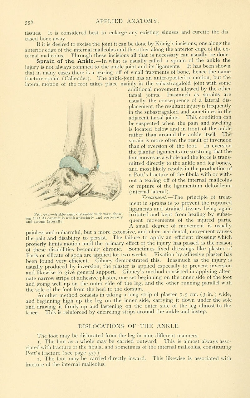 sinuses and curette the dis tissues. It is considered best to enlarge any existing eased bone away. If it is desired to excise tlie joint it can be done by Konig's incisions, one along the anterior edge of the internal malleolus and the other along the anterior edge of the ex- ternal malleolus. Through these incisions all that is necessary can usually be done. Sprain of the Ankle.—In what is usually called a sprain of the ankle the injury is not always confined to the ankle-joint and its ligaments. It has been shown that in many cases there is a tearing off of small fragments of bone, hence the name fracture-sprain CCallender). The ankle-joint has an anteroposterior motion,_ but the lateral motion of the foot takes place mainly in the subastragaloid joint with some additional movement allowed by the other tarsal joints. Inasmuch as sprains are usually the consequence of a lateral dis- placement, the resultant injury is frequently in the subastragaloid and sometimes in the adjacent tarsal joints. This condition can be suspected when the pain and swelling is located below and in front of the ankle rather than around the ankle itself. The sprain is more often the result of inversion than of eversion of the foot. In eversion the plantar ligaments are so strong that the foot moves as a whole and the force is trans- mitted directly to the ankle and leg bones, and most likely results in the production of a Pott's fracture of the fibula with or with- out a tearing off of the internal malleolus or rupture of the ligamentum deltoideum (internal lateral). Treatment.-'—'Y\\(i principle of treat- ment in sprains is to prevent the ruptured ligaments and strained tissues being again irritated and kept from healing by subse- quent movements of the injured parts. A small degree of movement is usually painless and unharmful, but a more extensive, and often accidental, movement causes the pain and disability to persist. The failure to apply an efficient dressing which properly limits motion until the primary effect of the injury has passed is the reason of these disabilities becoming chronic. Sometimes fixed dressings like plaster of Paris or silicate of soda are applied for two weeks. Fixation by adhesive plaster has been found very efficient. Gibney demonstrated this. Inasmuch as the injury is usually produced by inversion, the plaster is applied especially to prevent inversion and likewise to give general support. Gibney's method consisted in applying alter- nate narrow strips of adhesive plaster, one set beginning on the inner side of the foot and going well up on the outer side of the leg, and the other running parallel with the sole of the foot from the heel to the dorsum. Another method consists in taking a long strip of plaster 7.5 cm. (3 in.) wide, and beginning high up the leg on the inner side, carrying it down under the sole and drawing it firmly up and fastening on the outer side of the leg almost to the knee. This is reinforced by encircling strips around the ankle and instep. Fig. 571.—^Ankle-joint distended with wax. show- ng that its capsule is weak anteriorly and posteriorly md strong laterally. DISLOCATIONS OF ■ THE ANKLE. The foot may be dislocated from the leg in nine different manners. 1. The foot as a whole may be carried outward. This is almost always asso- ciated with fracture of the fibula, and sometimes of the internal malleolus, constituting Pott's fracture (see page 557). 2. The foot may be carried directly inward. This likewise is associated with fracture of the internal malleolus.