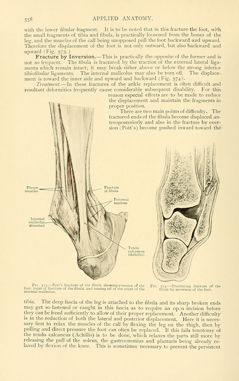 SS8 with the lower fibular fragment. It is to be noted that in this fracture the foot, with the small fragments of tibia and fibula, is practically loosened from the bones of the leg, and the muscles of the calf being unopposed pull the foot backward and upward. Therefore the displacement of the foot is not only outward, but also backward and upward (Fig. 573.) Fracture by Inversion.—This is practically the opposite of the former and is not so frequent. The fibula is fractured by the traction of the external lateral liga- ments which remain intact; it may break either above or below the strong inferior tibiofibular ligaments. The internal malleolus may also be torn off. The displace- ment is toward the inner side and upward and backward (Fig. 574). Treatmeyit. — In these fractures of the ankle replacement is often difficult and resultant deformities frequently cause considerable subsequent disability. For this reason especial efforts are to be made to reduce the displacement and maintain the fragments in proper position. There are two main points of difficult3\ The fractured ends of the fibula become displaced an- teroposteriorly and also in the fracture by ever- sion (Pott's) become pushed inward toward the Fig. 573.—Potfs fracture of the fibula, showing eversion of the Fig. s74.—Illustrating fracture of the toot, point of fracture of the fibula, and teanng off of the point of the fibula by inversion of the foot internal malleolus. tibia. The deep fascia of the leg is attached to the fibula and its sharp broken ends may get so fastened or caught in this fascia as to require an open incision before they can be freed suiificiendy to allow of their proper replacement. Another difficulty is in the reduction of both the lateral and posterior displacement. Here it is neces- sary first to relax the muscles of the calf by flexing the leg on the thigh, then by pulling and direct pressure the foot can often be replaced. If this fails tenotomy of the tendo calcaneus (Achillis) is to be done, which relaxes the parts still more by releasing the pull of the soleus, the gastrocnemius and plantaris being already re- laxed by flexion of the knee. This is sometimes necessary to prevent the persistent
