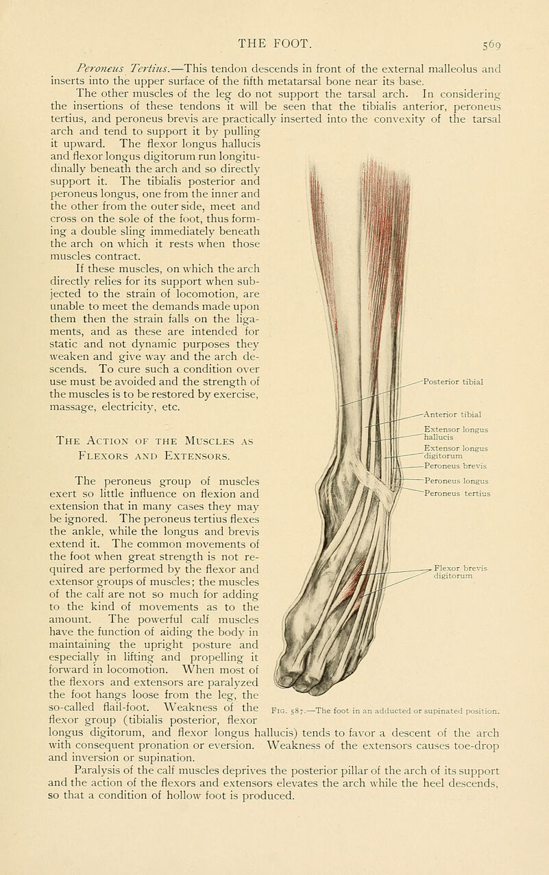Peronens Tertms.—This tendon descends in front of the external malleolus and inserts into the upper surface of the fifth metatarsal bone near its base. The other muscles of the leg do not support the tarsal arch. In considering the insertions of these tendons it will be seen that the tibialis anterior, peroneus tertius, and peroneus brevis are practically inserted into the convexity of the tarsal arch and tend to support it by pulling it upward. The flexor longus hallucis and flexor longus digitorum run longitu- dmally beneath the arch and so directly support it. The tibialis posterior and peroneus longus, one from the inner and the other from the outer side, meet and cross on the sole of the foot, thus form- ing a double sling immediately beneath the arch on which it rests when those muscles contract. If these muscles, on which the arch directly relies for its support when sub- jected to the strain of locomotion, are unable to meet the demands made upon them then the strain falls on the liga- ments, and as these are intended for static and not dynamic purposes they weaken and give way and the arch de- scends. To cure such a condition over use must be avoided and the strength of the muscles is to be restored by exercise, massage, electricity, etc. -interior tibial The Action of the Muscles as Flexors and Extensors. Extensor longus digitorum Peroneus brevis Peroneus longus Peroneus tertius The peroneus group of muscles exert so little influence on flexion and extension that in many cases they may be ignored. The peroneus tertius fle.xes the ankle, while the longus and brevis extend it. The common movements of the foot when great strength is not re- quired are performed by the fle.xor and e.xtensor groups of muscles; the muscles of the calf are not so much for adding to the kind of movements as to the amount. The powerful calf muscles have the function of aiding the body in maintaining the upright posture and especially in lifting and propelling it forward in locomotion. When most of the flexors and extensors are paralyzed the foot hangs loose from the leg, the so-called flail-foot. Weakness of the flexor group (tibialis posterior, flexor longus digitorum, and flexor longus hallucis) tends to favor a descent of the arch with consequent pronation or eversion. Weakness of the extensors causes toe-drop and inversion or supination. Paralysis of the calf muscles deprives the posterior pillar of the arch of its support and the action of the flexors and extensors elevates the arch while the heel descends, so that a condition of hollow foot is produced. Fig. 587.—The foot i adducted or supinated positic