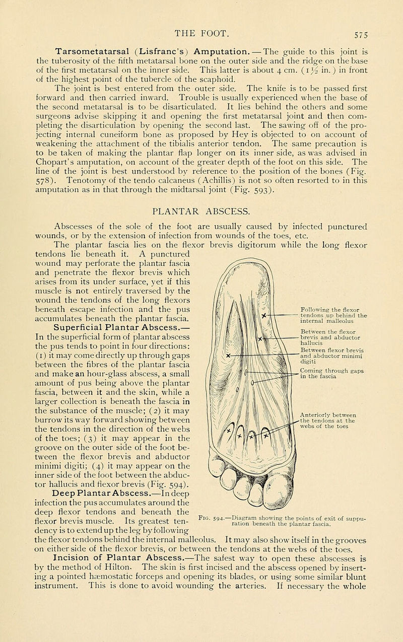 Tarsometatarsal (Lisfranc's) Amputation. — The guide to this joint is the tuberosity of the fifth metatarsal bone on the outer side and the ridge on the base of the first metatarsal on the inner side. This latter is about 4 cm. (1^2 in.) in front of the highest point of the tubercle of the scaphoid. The joint is best entered from the outer side. The knife is to be passed first forward and then carried inward. Trouble is usually experienced when the base of the second metatarsal is to be disarticulated. It lies behind the others and some surgeons advise skipping it and opening the first metatarsal joint and then com- pleting the disarticulation by opening the second last. The sawing off of the pro- jecting internal cuneiform bone as proposed by Hey is objected to on account of weakening the attachment of the tibialis anterior tendon. The same precaution is to be taken of making the plantar flap longer on its inner side, as was advised in Chopart's amputation, on account of the greater depth of the foot on this side. The line of the joint is best understood by reference to the position of the bones (Fig. 578). Tenotomy of the tendo calcaneus (Achillis) is not so often resorted to in this amputation as in that through the midtarsal joint (Fig. 593). PLANTAR ABSCESS. Abscesses of the sole of the foot are usually caused by infected punctured wounds, or by the extension of infection from wounds of the toes, etc. The plantar fascia lies on the flexor brevis digitorum while the long flexor tendons lie beneath it. A punctured _ wound may perforate the plantar fascia and penetrate the flexor brevis which arises from its under surface, yet if this muscle is not entirely traversed by the wound the tendons of the long flexors beneath escape infection and the pus accumulates beneath the plantar fascia. Superficial Plantar Abscess.— In the superficial form of plantar abscess the pus tends to point in four directions: (I) it may come directly up through gaps between the fibres of the plantar fascia and make an hour-glass abscess, a small amount of pus being above the plantar fascia, between it and the skin, while a larger collection is beneath the fascia in the substance of the muscle; (2) it may burrow its way forward showing between the tendons in the direction of the webs of the toes; (3) it may appear in the groove on the outer side of the foot be- tween the flexor brevis and abductor minimi digiti; (4) it may appear on the inner side of the foot between the abduc- tor hallucis and fiexor brevis (Fig. 594). Deep Plantar Abscess.—In deep infection the pus accumulates around the deep flexor tendons and beneath the flexor brevis muscle. Its greatest ten- dency is to extend up the leg by following the fle.xor tendons behind the internal malleolus. It may also show itself in the grooves on either side of the flexor brevis, or between the tendons at the webs of the toes. Incision of Plantar Abscess.—The safest way to open these abscesses is by the method of Hilton. The skin is first incised and the abscess opened by insert- ing a pointed haemostatic forceps and opening its blades, or using some similar blunt instrument. This is done to avoid wounding the arteries. If necessary the whole Following the flexor tendons up behind the internal malleolus Between the flexor brevis and abductor hallucis Between flexor brevis and abductor minimi digiti Anteriorly between the tendons at the webs of the toes -Diagram showing the points of exit of suppu- ration beneath the plantar fascia.