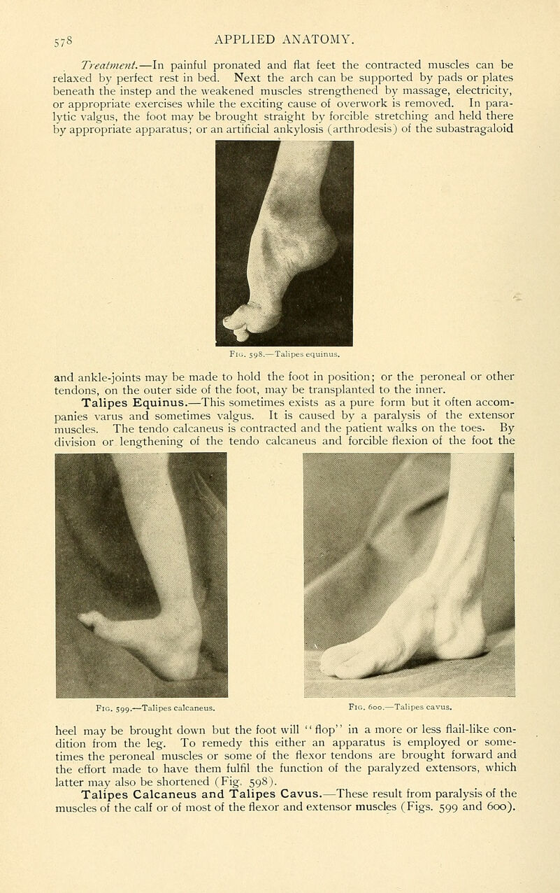 S7S Treatment.—In painful pronated and flat feet the contracted muscles can be relaxed by perfect rest in bed. Next the arch can be supported by pads or plates beneath the instep and the weakened muscles strengthened by massage, electricity, or appropriate exercises while the exciting cause of overwork is removed. In para- lytic valgus, the foot may be brought straight by forcible stretching and held there by appropriate apparatus; or an artificial ankylosis (arthrodesis) of the subastragaloid and ankle-joints may be made to hold the foot in position; or the peroneal or other tendons, on the outer side of the foot, may be transplanted to the inner. Talipes Equinus.—This sometimes exists as a pure form but it often accom- panies varus and sometimes valgus. It is caused by a paralysis of the extensor muscles. The tendo calcaneus is contracted and the patient walks on the toes. By division or lengthening of the tendo calcaneus and forcible flexion of the foot the Fig. 599.—Talipes calcaneus. Fig. 600.—Talipes cavus. heel may be brought down but the foot will  flop in a more or less flail-like con- dition from the leg. To remedy this either an apparatus is employed or some- times the peroneal muscles or some of the flexor tendons are brought forward and the effort made to have them fulfil the function of the paralyzed extensors, which latter may also be shortened (Fig. 598 ). Talipes Calcaneus and Talipes Cavus.—These result from paralysis of the muscles of the calf or of most of the flexor and extensor muscles (Figs. 599 and 600).