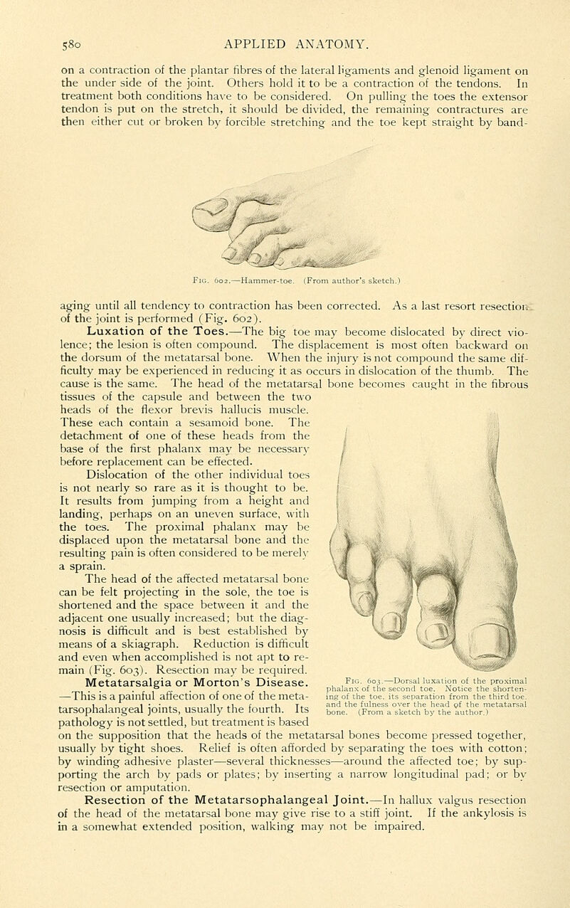 on a contraction of the plantar fibres of the lateral ligaments and glenoid ligament on the under side of the joint. Others hold it to be a contraction of the tendons. In treatment both conditions have to be considered. On pulling the toes the extensor tendon is put on the stretch, it should be divided, the remaining contractures are then either cut or broken by forcible stretching and the toe kept straight by band- FlG. 602.—H, aging until all tendency to contraction has been corrected. As a last resort resection of the joint is performed (Fig. 602). Luxation of the Toes.—The big toe may become dislocated by direct vio- lence; the lesion is often compound. The displacement is most often backward on the dorsum of the metatarsal bone. When the injury is not compound the same dif- ficulty may be experienced in reducing it as occurs in dislocation of the thumb. The cause is the same. The head of the metatarsal bone becomes caught in the fibrous tissues of the capsule and between the two heads of the fle.xor brevis hallucis muscle. These each contain a sesamoid bone. The detachment of one of these heads from the j base of the first phalanx may be necessar\^ before replacement can be effected. Dislocation of the other individual toes is not nearly so rare as it is thought to be. It results from jumping from a height and landing, perhaps on an uneven surface, with the toes. The proximal phalanx may be displaced upon the metatarsal bone and the resulting pain is often considered to be mere))- a sprain. The head of the affected metatarsal bone can be felt projecting in the sole, the toe is shortened and the space between it and the adjacent one usually increased; but the diag- nosis is difficult and is best established by means of a skiagraph. Reduction is difificult and even when accomplished is not apt to re- main (Fig. 603). Resection may be required. Metatarsalgia or Morton's Disease. —This is a painful affection of one of the meta- tarsophalangeal joints, usually the fourth. Its pathology is not settled, but treatment is based on the supposition that the heads of the metatarsal bones become pressed together, usually by tight shoes. Relief is often afforded by separating the toes with cotton; by winding adhesive plaster—several thicknesses—around the affected toe; by sup- porting the arch by pads or plates; by inserting a narrow longitudinal pad; or by resection or amputation. Resection of the Metatarsophalangeal Joint.—In hallux valgus resection of the head of the metatarsal bone may give rise to a stiff joint. If the ankylosis is in a somewhat extended position, walking may not be impaired. Fig. 603 - phalanx of the s ing of the toe. i and the fulness bone. (From a Dorsal luxation of the proximal =cond toe. Notice the shorten- .s separation from the third toe. 3ver the head gf the metatarsal sketch by the author.)