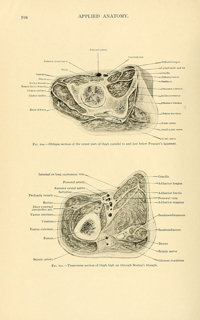 Anterior en ral Tensor fascia; femoris, Gluteus .Adductor longiis Lymph-node and fat Head of femui Fig. 620.—Oblique section of the upper part of thigh parallel to and just below Poupart's ligament. Internal or long saphi Profunda vessels Rectus Gracilis 'Adductor longus Adductor brevis Femoral vein ^ —Adductor magnus Semimembranosus Gluteus maximus Fig. 621.—Transverse section of thigh high up through Scarpa's triangle.