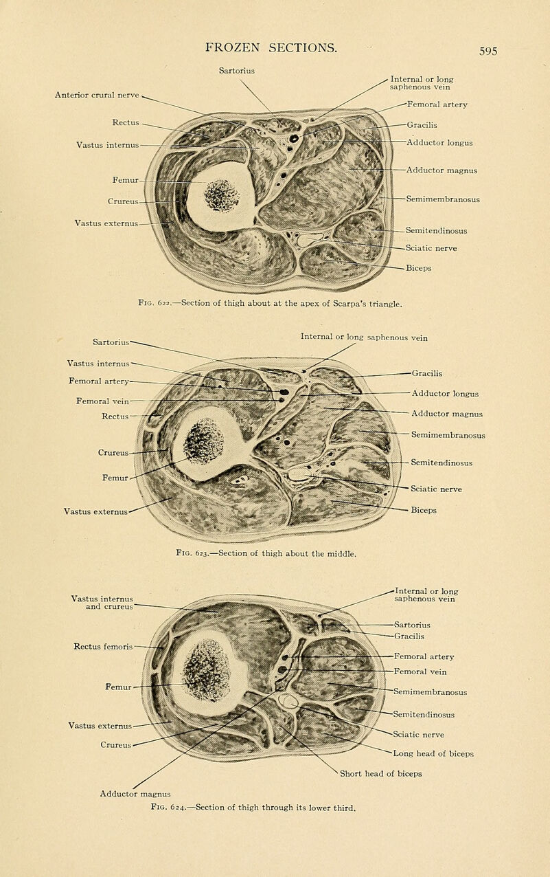 Sartorius 595 Anterior crural Vastus intemus — Vastus externus Sartorius Vastus internus Femoral arti r>' Femoral vem '. Fig. 622.—Section of thigh about at the apex of Scarpa's triangle. Internal or long saphenous vein Vastus externus ■Gracilis Adductor longus Adductor magnus Semimembranosus Fig. 623.—Section of thigh about the middle. Rectus femoris Vastus externus ^' Crureus Internal or long saphenous vein Sartorius Gracilis Femoral artery Femoral vein Semimembranosus Semitendinosus Sciatic nerve Long head of biceps Short head of biceps Adductor magnu Fig. 624.—Section of thigh through its lower third.