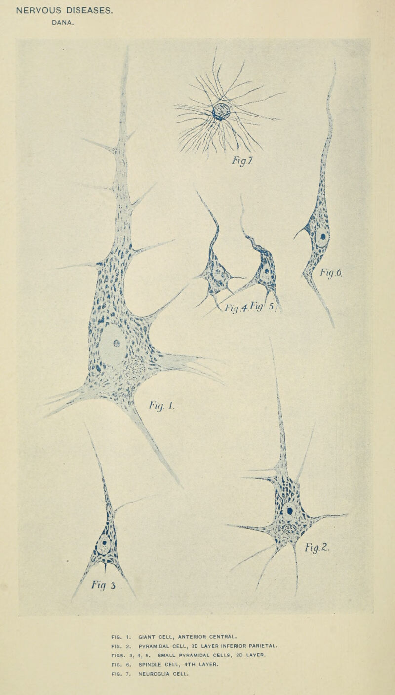 NERVOUS DISEASES. DANA. in f,g7 n\ #1 I fc MM t %-2. FIG. 1. GIANT CELL, ANTERIOR CENTRAL. FIG. 2. PYRAMIDAL CELL, 3D LAYER INFERIOR PARIETAL. FIGS. 3, 4, 5. SMALL PYRAMIDAL CELLS, 2D LAYER. FIG. 6. SPINDLE CELL, 4TH LAYER. FIG. 7. NEUROGLIA CELL.