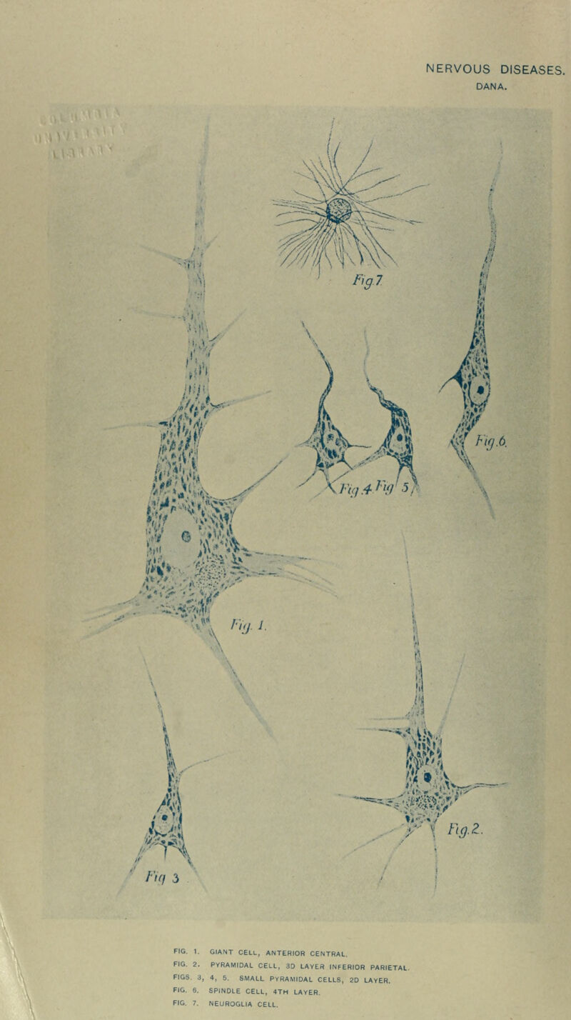 NERVOUS DISEASES. DANA. m ■ •.... ,y . ••.if' 1 I W tt& % Fig.6, 4 la fi<?.2. FIG. I. GIANT CELL, ANTERIOR CENTRAL. FIG. 2. PYRAMIDAL CELL, 3D LAYER INFERIOR PARIETAL. FIGS. 3, 4, 5. SMALL PYRAMIDAL CELLS, 2D LAYER. FIG. 6. SPINDLE CELL, 4TH LAYER. FIG. 7. NEUROGLIA CELL.