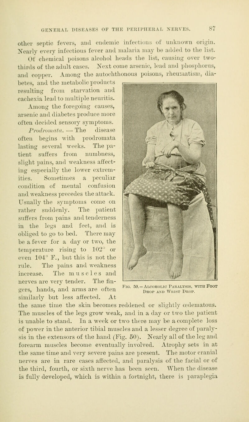 other septic fevers, and endemic infections of unknown origin. Nearly every infectious Eever and malaria may be added to the list. Of chemical poisons alcohol heads the list, causing over two- thirds of the adult cases. Next come arsenic, lead and phosphorus, ami copper. Among the autochthonous poisons, rheumatism, dia- betes, and the metabolic products resulting from starvation and cachexia lead to multiple neuritis. Among the foregoing causes, arsenic and diabetes produce more often decided sensory symptoms. Prodromata. —The disease often begins with prodromata lasting several weeks. The pa- tient suffers from numbness, slight pains, and weakness affect- ing especially the lower extrem- ities. Sometimes a peculiar condition of mental confusion and weakness precedes the attack. Usually the symptoms come on rather suddenly. The patient suffers from pains and tenderness in the legs and feet, and is obliged to go to bed. There may be a fever for a day or two, the temperature rising to 102° or even 104° F., but this is not the rule. The pains and weakness increase. The muscles and nerves are very tender. The fin- gers, hands, and arms are often similarly but less affected. At the same time the skin becomes reddened or slightly oedematous. The muscles of the legs grow weak, and in a day or two the patient is unable to stand. In a week or two there may be a complete loss of power in the anterior tibial muscles and a lesser degree of paraly- sis in the extensors of the hand (Fig. 50). Nearly all of the leg and forearm muscles become eventually involved. Atrophy sets in at the same time and very severe pains are present. The motor cranial nerves are in rare cases affected, and paralysis of the facial or of the third, fourth, or sixth nerve has been seen. When the disease is fully developed, which is within a fortnight, there is paraplegia Fig. 50. -Alcoholic Paralysis, with Foot Drop and Wrist Drop.