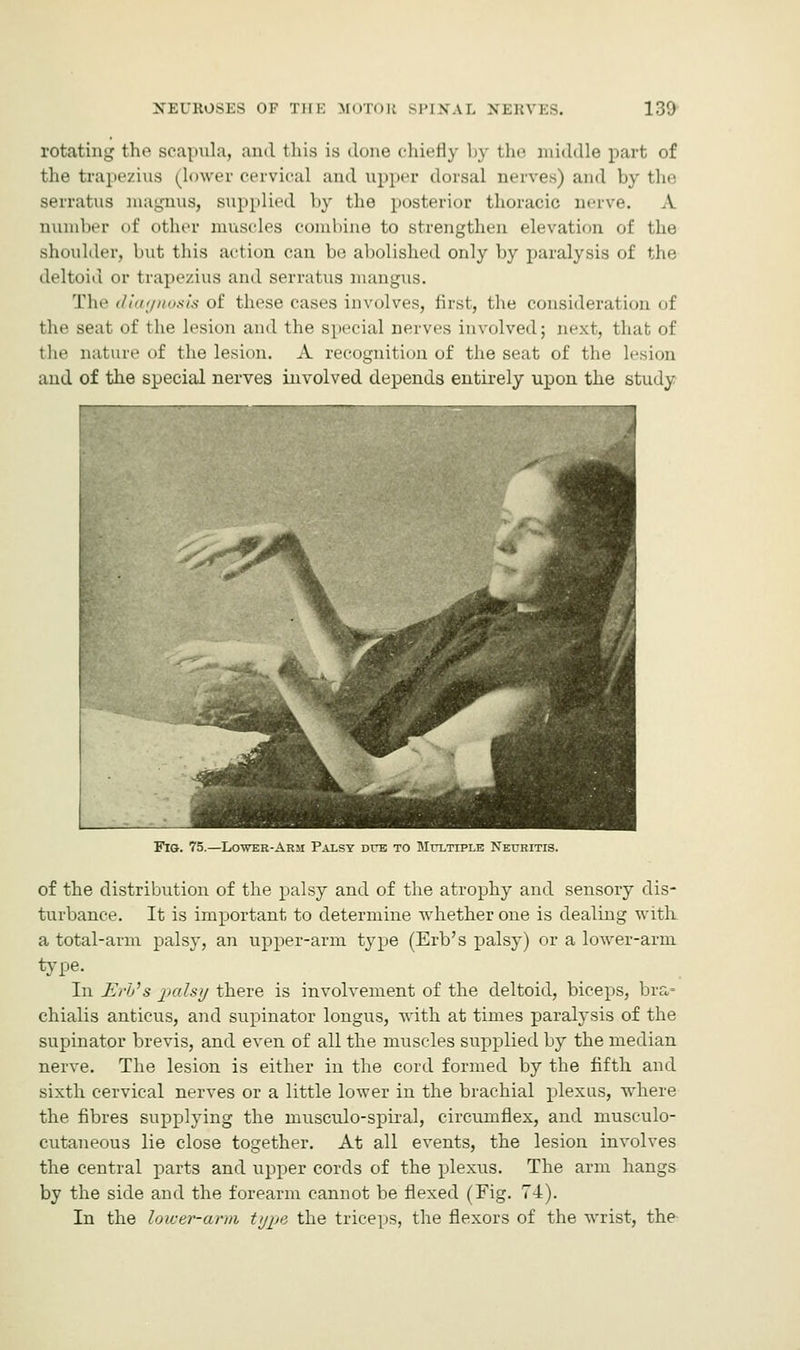 rotating the scapula, and this is done chiefly by the middle part of the trapezius (lower cervical and upper dorsal nerves) and by the serratus magnus, supplied by the posterior thoracic nerve. A number of other muscles combine to strengthen elevation of the shoulder, but this action can be abolished only by paralysis of the deltoid or trapezius and serratus mangus. The diagnosis of. these cases involves, first, the consideration of the seat of the lesion and the special nerves involved; next, that of the nature of the lesion. A recognition of the seat of the lesion and of the special nerves involved depends entirely upon the study Fig. 75.—Lower-Arm Palsy dub to Multiple Neuritis. of the distribution of the palsy and of the atrophy and sensory dis- turbance. It is important to determine whether one is dealing with a total-arm palsy, an upper-arm type (Erb's palsy) or a lower-arm type. In Erb's palsy there is involvement of the deltoid, biceps, bra= chialis anticus, and supinator longus, with at times paralysis of the supinator brevis, and even of all the muscles supplied by the median nerve. The lesion is either in the cord formed by the fifth and sixth cervical nerves or a little lower in the brachial plexus, where the fibres supplying the musculo-spiral, circumflex, and musculo- cutaneous lie close together. At all events, the lesion involves the central parts and upper cords of the plexus. The arm hangs by the side and the forearm cannot be flexed (Fig. 74). In the lower-arm type the trice] is, the flexors of the wrist, the