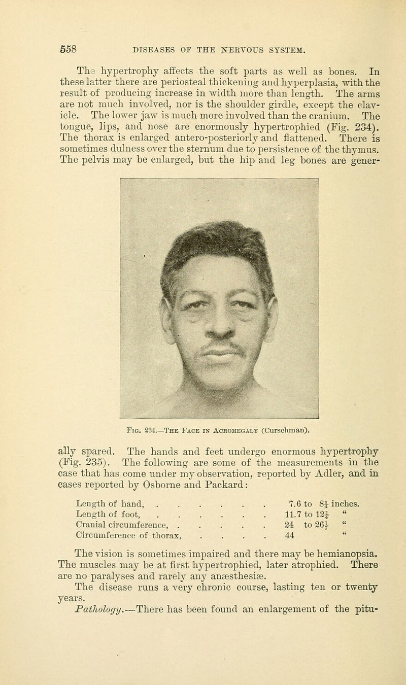 The hypertrophy affects the soft parts as well as bones. In these latter there are periosteal thickening and hyperplasia, with the result of producing increase in width more than length. The arms are not much involved, nor is the shoulder girdle, except the clav- icle. The lower jaw is much more involved than the cranium. The tongue, lips, and nose are enormously hypertrophied (Fig. 234). The thorax is enlarged antero-posteriorly and flattened. There is sometimes dulness over the sternum due to persistence of the thymus. The pelvis may be enlarged, but the hip and leg bones are gener- Fig. 234.—The Face in Acromegaly (Curschman). ally spared. The hands and feet undergo enormous hypertrophy (Fig. 235). The following are some of the measurements in the case that has come under my observation, reported by Adler, and in cases reported by Osborne and Packard: Length of hand, Length of foot, Cranial circumference, . Circumference of thorax, 7.6 to 8f inches. 11.7 to 124; « 24 to 26 J-  44 The vision is sometimes impaired and there may be hemianopsia. The muscles may be at first hypertrophied, later atrophied. There are no paralyses and rarely any anaesthesias. The disease runs a very chronic course, lasting ten or twenty years. Pathology.—There has been found an enlargement of the pitu-