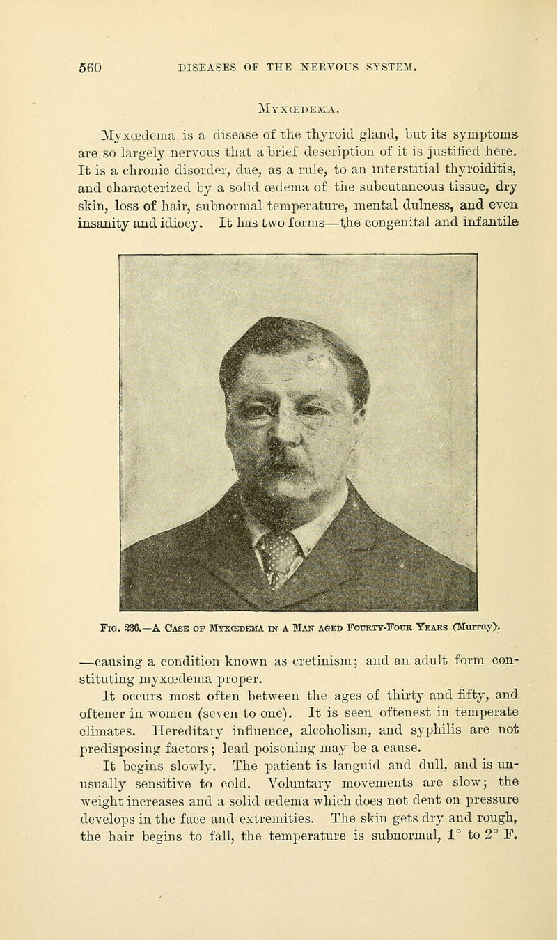 Myxoedema. Myxcedeina is a disease of the thyroid gland, but its symptoms. are so largely nervous that a brief description of it is justified here. It is a chronic disorder, due, as a rule, to an interstitial thyroiditis, and characterized by a solid oedema of the subcutaneous tissue, dry skin, loss of hair, subnormal temperature, mental dulness, and even insanity and idiocy. It has two forms—t^ie congenital and inf antile Fig. 236.—A Case op Myxcedema in a Man aged Fottrty-Four Years (Murray). ■—causing a condition known as cretinism; and an adult form con- stituting myxoedema proper. It occurs most often between the ages of thirty and fifty, and oftener in women (seven to one). It is seen oftenest in temperate climates. Hereditary influence, alcoholism, and syphilis are not predisposing factors; lead poisoning may be a cause. It begins slowly. The patient is languid and dull, and is un- usually sensitive to cold. Voluntary movements are slow; the weight increases and a solid oedema which does not dent on pressure develops in the face and extremities. The skin gets dry and rough, the hair begins to fall, the temperature is subnormal, 1° to 2° I\
