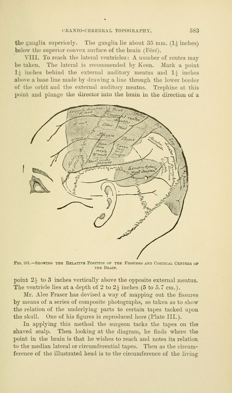 the ganglia superiorly. The ganglia lie about 35 trim. (1-J inches) below the superior convex surface of the brain | Fe'rd). VIII. To reach the lateral ventricles: A number of routes inay be taken. The lateral is recommended by Keen. Mark a point 1 | inches behind the external auditory meatus and 1 \ inches above a base line made by drawing a line through the lower border of the orbit and the external auditory meatus. Trephine at this point and plunge the director into the brain in the direction of a Fig. 241.—Showing the Relative Position of the Fissures and Cortical Centres of the Brain. point 24- to 3 inches vertically above the opposite external meatus. The ventricle lies at a depth of 2 to 2\ inches (5 to 5.7 cm.). Mr. Alec Fraser has devised a way of mappiug out the fissures by means of a series of composite photographs, so taken as to show the relation of the underlying parts to certain tapes tacked upon the skull. One of his figures is reproduced here (Plate III.). In applying this method the surgeon tacks the tapes on the shaved scalp. Then looking at the diagram, he finds where the point in the brain is that he wishes to reach and notes its relation to the median lateral or circumferential tapes. Then as the circum- ference of the illustrated head is to the circumference of the living