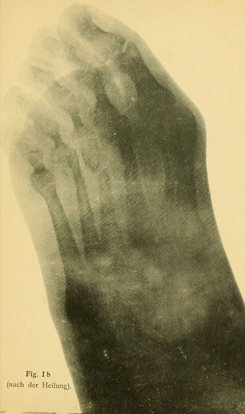 '%>f Fig. Ib (nach der Heilung