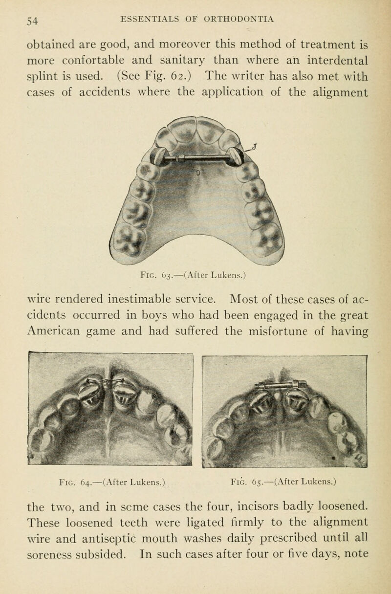 obtained are good, and moreover this method of treatment is more conf or table and sanitary than where an interdental splint is used. (See Fig. 62.) The writer has also met with cases of accidents where the application of the alignment Fig. 63.—(After Liikens.) wire rendered inestimable service. Most of these cases of ac- cidents occurred in boys who had been engaged in the great American game and had suffered the misfortune of having ■ ^^ ^0 \'4 i^ Fig. 64.—(After Lukens.) Fig. 65.—(After Lukens.) the two, and in seme cases the four, incisors badly loosened. These loosened teeth were ligated firmly to the alignment wire and antiseptic mouth washes daily prescribed until all soreness subsided. In such cases after four or five days, note