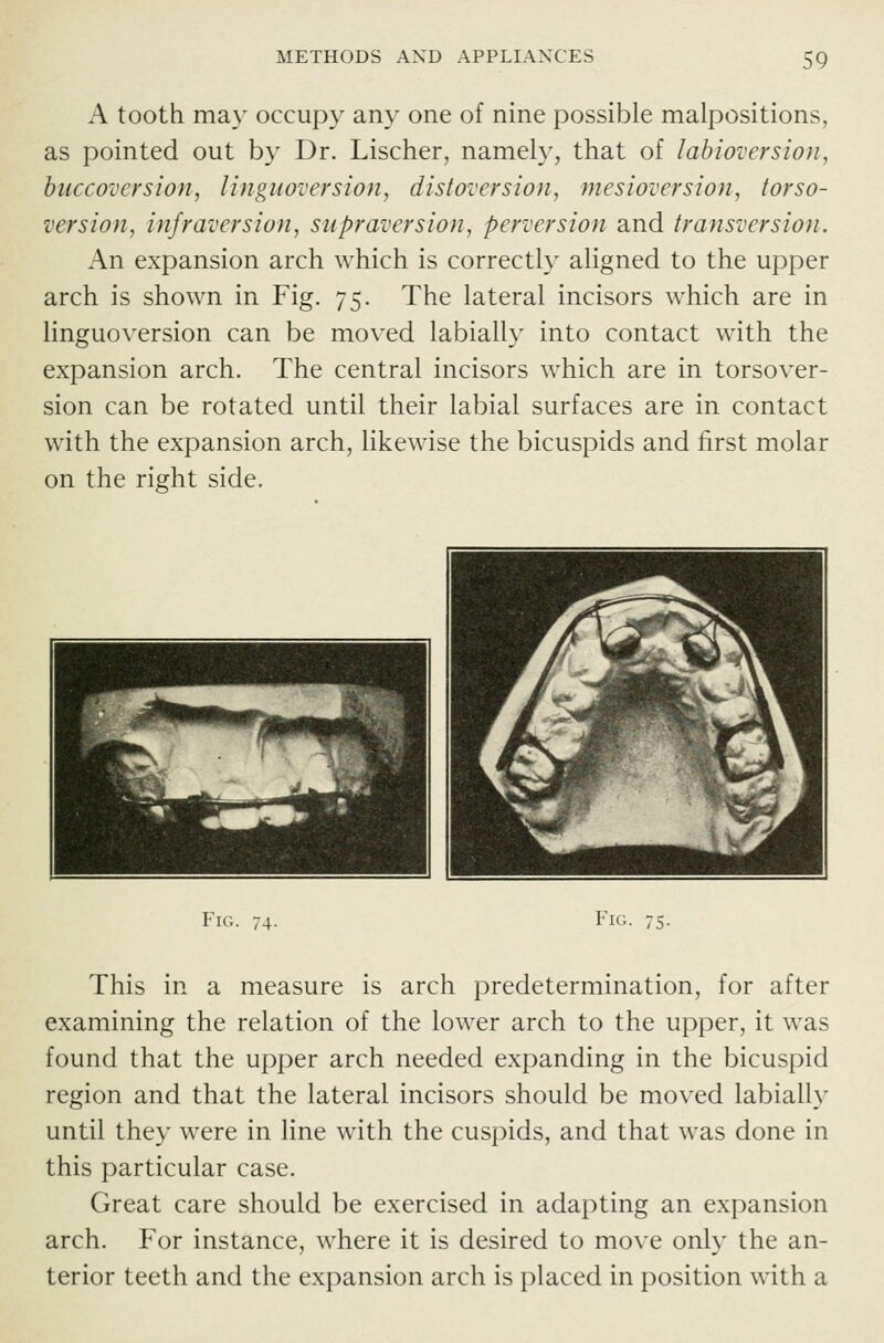A tooth may occupy any one of nine possible malpositions, as pointed out by Dr. Lischer, namely, that of lahioversion, hiiccovcrsion, linguoversion, distoversioji, mesioversion, torso- version, infraversion, supraversion, perversion and transversion. An expansion arch which is correctly aligned to the upper arch is shown in Fig. 75. The lateral incisors which are in linguoversion can be moved labially into contact with the expansion arch. The central incisors which are in torsover- sion can be rotated until their labial surfaces are in contact with the expansion arch, likewise the bicuspids and first molar on the right side. Fig. 74. Fig. 75. This in a measure is arch predetermination, for after examining the relation of the lower arch to the upper, it was found that the upper arch needed expanding in the bicuspid region and that the lateral incisors should be moved labially until they were in line with the cuspids, and that was done in this particular case. Great care should be exercised in adapting an expansion arch. For instance, where it is desired to move only the an- terior teeth and the expansion arch is placed in position with a