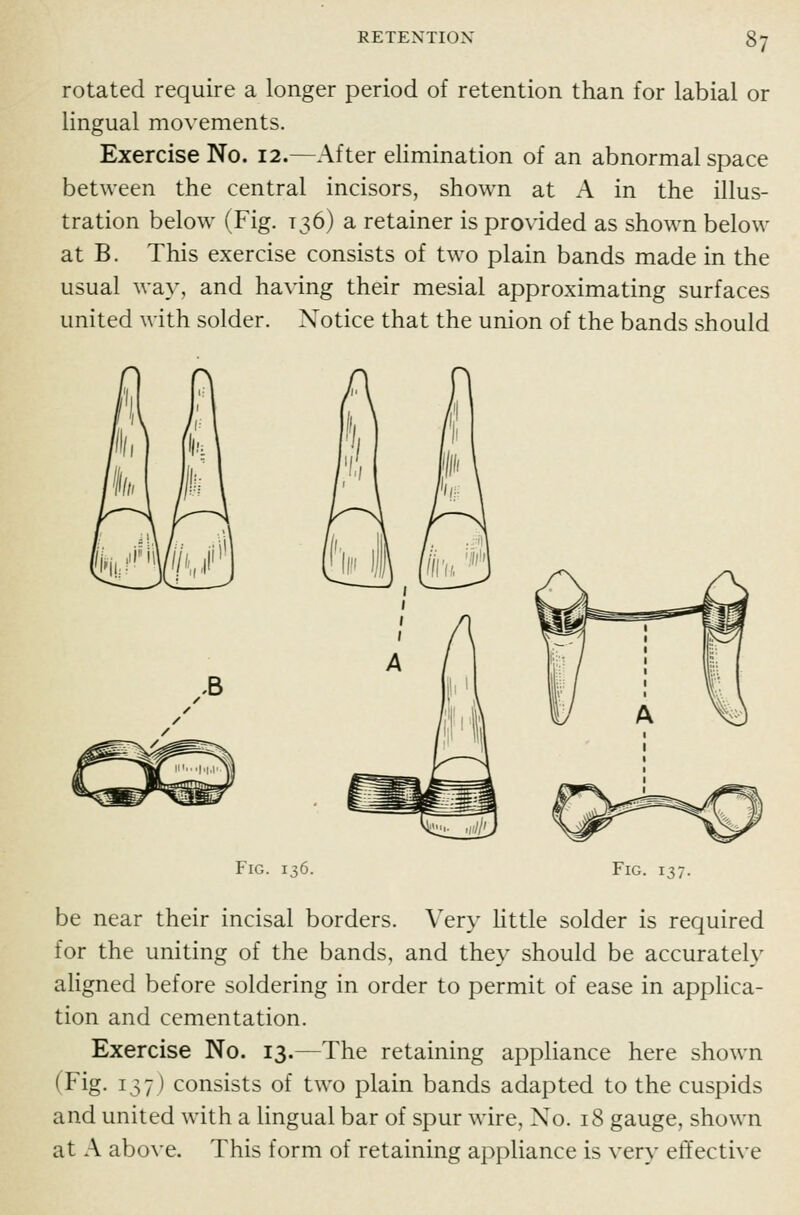 rotated require a longer period of retention than for labial or lingual movements. Exercise No. 12.—After elimination of an abnormal space between the central incisors, shown at A in the illus- tration below (Fig. 136) a retainer is provided as shown below at B. This exercise consists of two plain bands made in the usual way, and having their mesial approximating surfaces united with solder. Notice that the union of the bands should Fig. 136. Fig. 137. be near their incisal borders. Very little solder is required for the uniting of the bands, and they should be accurately aligned before soldering in order to permit of ease in applica- tion and cementation. Exercise No. 13.—The retaining appliance here shown (Fig. 137) consists of two plain bands adapted to the cuspids and united with a lingual bar of spur wire, No. 18 gauge, shown at A above. This form of retaining appliance is very effective