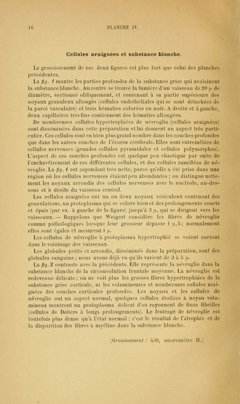 Cellules araignées et substance blanche. Le grossissement de ces deux figures est plus fort que celui des planches précédentes. La fig. 1 montre les parties profondes de la substance grise qui avoisinent la substance blanche. Au centre se trouve la lumière d'un vaisseau de 20 ij. de diamètre, sectionné obliquement, et contenant à sa partie supérieure des noyaux granuleux allongés (cellules endotiiéliales qui se sont détachées de la paroi vasculaire) et trois hématies colorées en noir. A droite et à gauche, deux capillaires très fins contiennent des hématies allongées. De nombreuses cellules hypertrophiées de névroglie (cellules araignées) sont disséminées dans cette préparation et lui donnent un aspect très parti- culier. Ces cellules sont en bien plus grand nombre dans les couches profondes que dans les autres couches de l'écorce cérébrale. Elles sont entremêlées de cellules nerveuses (grandes cellules pyramidales et cellules polymorphes). L'aspect de ces couches profondes est quelque peu chaotique par suite de l'enchevêtrement de ces différentes cellules, et des cellules ramifiées de né- vroglie. La ftg. ■/ est cependant tiès nelte, parce qu'elle a été prise dans une région où les cellules nerveuses étaient peu abondantes ; on distingue nette- ment les noyaux arrondis des cellules nerveuses avec le nucléole, au-des- sous et à droite du vaisseau central. Les cellules araignées ont un ou deux noyaux vésiculeux contenant des granulations, un protoplasma qui se colore bien et des prolongements courts et épais (par ex. à gauche de la figure) jusqu'à 3 \i, qui se dirigent vers les vaisseaux. — Rappelons que ^Veigerl considère les fibres de névroglie comme pathologiques lorsque leur grosseur dépasse 1 îj-,5; normalement elles sont égales et mesurent i tx. Les cellules de névroglie à protoplasma hypertrophié se voient surtout dans le voisinage des vaisseaux. Les globules petits et arrondis, disséminés dans la préparation, sont des globules sanguins ; nous avons déjcà vu qu'ils varient de 3 à K [i.. La fig. 2 contraste avec la précédente. Elle représente la névroglie dans la substance blanche de la circonvolution frontale moyenne. La névroglie est redevenue délicate; on ne voit plus les grosses fibres hypertrophiées de la substance grise corticale, ni les volumineuses et nombreuses cellules arai- gnées des couches corticales profondes. Les noyaux et les cellules de névroglie ont un aspect normal, quelques cellules étoilées à noyau volu- mineux montrent un protoplasma délicat d'où rayonnent de fines fibrilles (cellules de Deiters à longs prolongements). Le feutrage de névroglie est toutefois plus dense qu'à l'état normal : c'est le résultat de l'atrophie et de la disparition des fibres à myéline dans la sul)stance blanche.