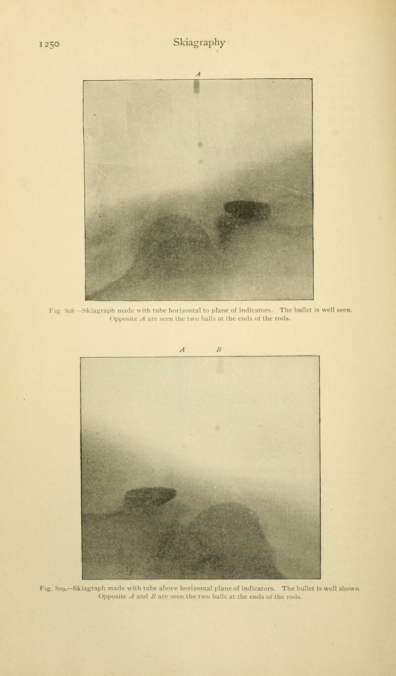 Fig 3o8 —Skiagraph made with tube horizontal to plane of indicators. The bullet is well seen. Opposite A are seen the two balls at the ends of the rods. Fig. ^09.—Skiagraph made with tube above horizontal plane of indicators. The bl i Opposite A and B are seen the two balls at the ends of the rods. _-t is well shown
