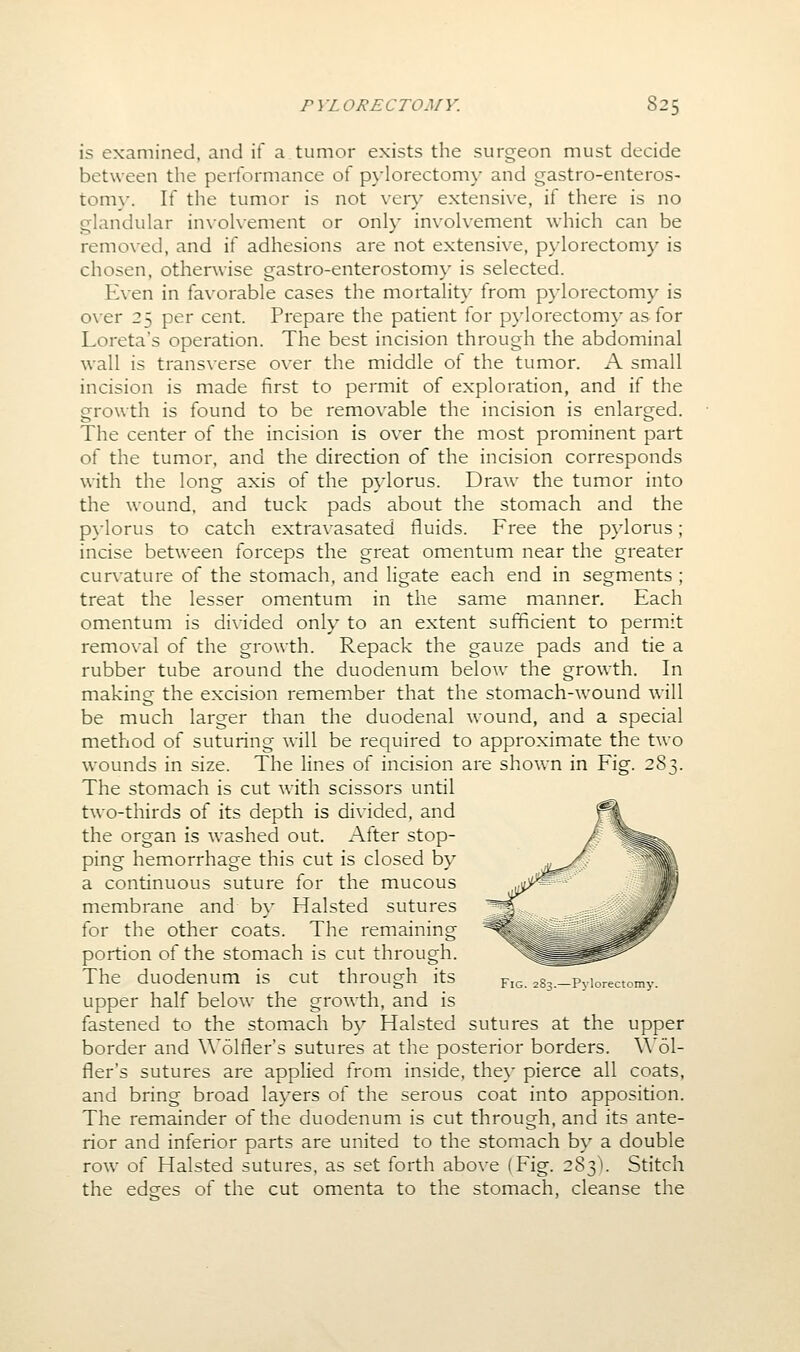 is examined, and if a tumor exists the surgeon must decide between the performance of pylorectomy and gastro-enteros- torn}-. If the tumor is not very extensive, if there is no glandular involvement or only involvement which can be removed, and if adhesions are not extensive, pylorectomy is chosen, otherwise gastro-enterostomy is selected. Even in favorable cases the mortality from p}-lorectom}' is over 25 per cent. Prepare the patient for pj'lorectomy as for Loreta's operation. The best incision through the abdominal wall is transverse over the middle of the tumor. A small incision is made first to permit of exploration, and if the growth is found to be removable the incision is enlarged. The center of the incision is over the most prominent part of the tumor, and the direction of the incision corresponds with the long axis of the pylorus. Draw the tumor into the wound, and tuck pads about the stomach and the pylorus to catch extravasated fluids. Free the pylorus; incise between forceps the great omentum near the greater curvature of the stomach, and ligate each end in segments ; treat the lesser omentum in the same manner. Each omentum is di\ided only to an extent sufficient to permit removal of the growth. Repack the gauze pads and tie a rubber tube around the duodenum below the growth. In making the excision remember that the stomach-wound will be much larger than the duodenal wound, and a special method of suturing will be required to approximate the two wounds in size. The lines of incision are shown in Fig. i'^^. The stomach is cut with scissors until two-thirds of its depth is divided, and the organ is washed out. After stop- ping hemorrhage this cut is closed by a continuous suture for the mucous membrane and b\- Halsted sutures for the other coats. The remaining portion of the stomach is cut through. The duodenum is cut through its fig. 283.-Pyiorectomy. upper half below the growth, and is fastened to the stomach by Halsted sutures at the upper border and Wolfler's sutures at the posterior borders. W'ol- fler's sutures are applied from inside, they pierce all coats, and bring broad layers of the serous coat into apposition. The remainder of the duodenum is cut through, and its ante- rior and inferior parts are united to the stomach by a double row of Halsted sutures, as set forth above (Fig. 283V Stitch the edsres of the cut omenta to the stomach, cleanse the