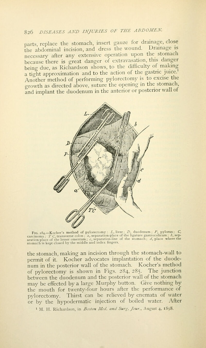 parts, replace the stomach, insert gauze for drainage, close the abdominal incision, and dress the wound. Drainage is necessary after any extensive operation upon the stomach because there is great danger of extravasation, this danger being due, as Richardson shows, to the difficulty of making a tight approximation and to the action of the gastric juice. Another method of performing pylorectomy is to excise the growth as directed above, suture the opening in the stomach and implant the duodenum in the anterior or posterior wall of Fig 284 —Kocher's method of pylorectomy : L, liver; D, duodenum ; P, pylorus ; C, carcinoma ; T C, transverse colon ; a, separation-place of the ligature gastrocolicum ; 6, sep- aration-place of the lesser omentum ; c, separation-line of the stomach; </, place where the stomach is kept closed by the middle and index fingers. the stomach, making an incision through the stomach-wall to permit of it. Kocher advocates implantation of the duode- num in the posterior wall of the stomach. Kocher's method of pylorectomy is shown in Figs. 284, 285. The junction between the duodenum and the posterior Avail of the stomach may be effected by a large Murphy button. Give nothing by the mouth for twenty-four hours after the performance of pylorectomy. Thirst can be relieved by enemata of water or by the hypodermatic injection of boiled water. After * M. H. Richardson, in Boston Med. and Surg. Jour., August 4, 1898.