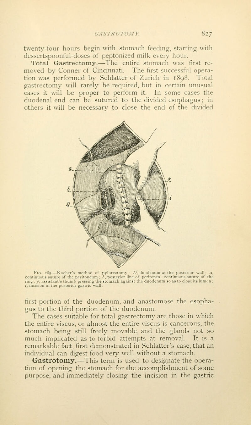 twenty-four hours begin with stomach feeding, starting with dessertspoonful-doses of peptonized milk every hour. Total Gastrectomy.—The entire stomach was first re- moved by Conner of Cincinnati. The first successful opera- tion was performed by Schlatter of Zurich in 189S. Total gastrectomy will rarely be required, but in certain unusual cases it will be proper to perform it. In some cases the duodenal end can be sutured to the divided esophagus; in others it will be necessar}' to close the end of the divided Fig. 2S5.—Kocher's method of pylorectomy: Z>, duodenum at the posterior wall; a, continuous suture of the peritoneum ; b, posterior line of peritoneal continuous suture of the ring; /, assistant's thumb pressing the stomach against the duodenum so as to close its lumen ; i, incision in the posterior gastric wall. first portion of the duodenum, and anastomose the esopha- gus to the third portion of the duodenum. The cases suitable for total gastrectom\- are those in which the entire viscus, or almost the entire viscus is cancerous, the stomach being still freely movable, and the glands not so much implicated as to forbid attempts at removal. It is a remarkable fact, first demonstrated in Schlatter's case, that an individual can digest food xtxy well without a stomach. Gastrotomy.—This term is used to designate the opera- tion of opening the stomach for the accomplishment of some purpose, and immediately closing the incision in the gastric
