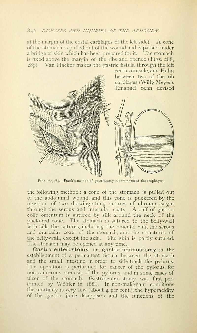 at the margin of the costal cartilages of the left side). A cone of the stomach is pulled out of the wound and is passed under a bridge of skin which has been prepared for it. The stomach is fixed above the margin of the ribs and opened (Figs. 288, 289). Van Hacker makes the gastric fistula through the left rectus muscle, and Hahn between two of the rib cartilages (Willy I\'Ieyer). Emanuel Senn devised Figs. 288, 289.—Frank's method of gastrostomy in carcinoma of the esophagus. the following method : a cone of the stomach is pulled out of the abdominal wound, and this cone is puckered by the insertion of two drawing-string sutures of chromic catgut through the serous and muscular coats. A cuff of gastro- colic omentum is sutured by silk around the neck of the puckered cone. The stomach is sutured to the belly-wall with silk, the sutures, including the omental cuff, the serous and muscular coats of the stomach, and the structures of the belly-wall, except the skin. The skin is partly sutured. The stomach may be opened at any time. Gastro-enterostomy or, g-astro-jejunostomy is the establishment of a permanent fistula between the stomach and the small intestine, in order to side-track the pylorus. The operation is performed for cancer of the pylorus, for non-cancerous stenosis of the pylorus, and in some cases of ulcer of the stomach. Gastro-enterostomy w^as first per- formed by Wolfler in 1881. In'non-maHgnant conditions the mortality is very low (about 4 per cent.), the hyperacidity of the gastric juice disappears and the functions of the