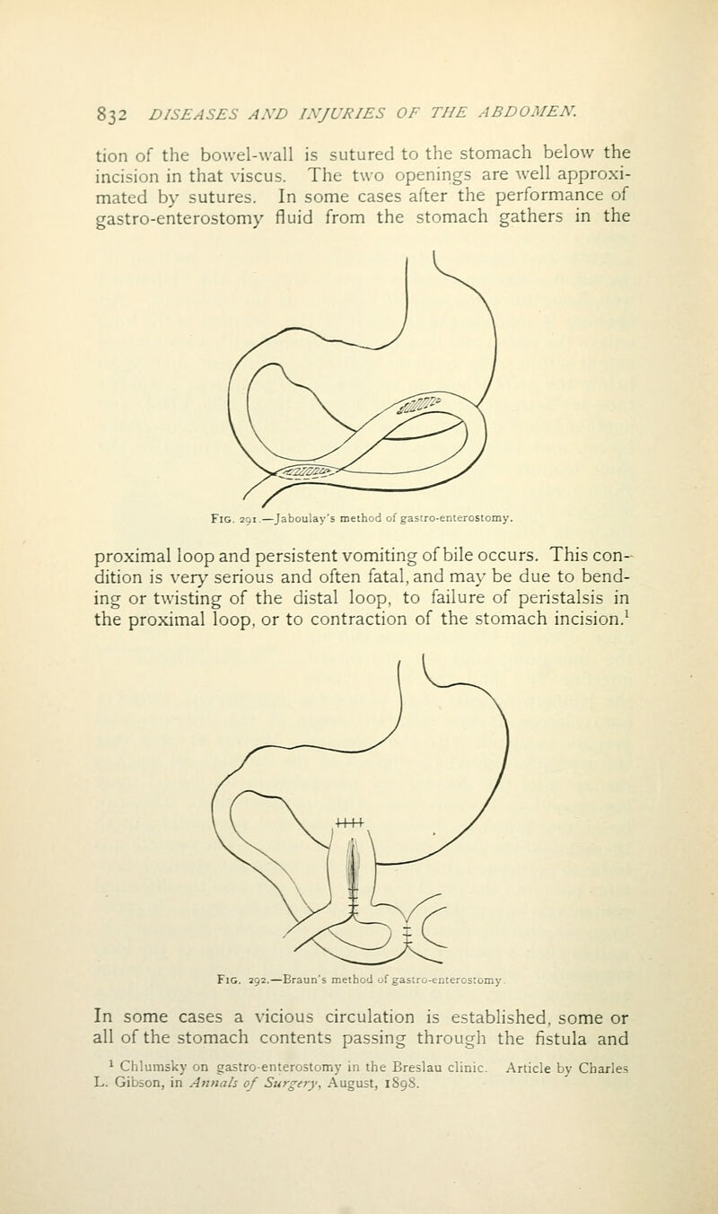 tion of the bowel-wall is sutured to the stomach below the incision in that viscus. The two openings are well approxi- mated by sutures. In some cases after the performance of gastro-enterostomy fluid from the stomach gathers in the Fig. 291.—Jaboulay's method of gastro-enterostomy. proximal loop and persistent vomiting of bile occurs. This con- dition is ver>'' serious and often fatal, and may be due to bend- ing or twisting of the distal loop, to failure of peristalsis in the proximal loop, or to contraction of the stomach incision.^ Fig. 292.—Braun's method of gasiro-enterostomy. In some cases a vicious circulation is established, some or all of the stomach contents passing through the fistula and 1 Chlumsky on gastro-enterostomy in the Breslau clinic. Article by Charle.s L. Gibson, in Annals of Surgery, August, 1898.