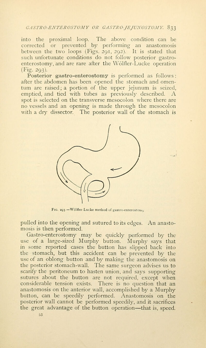 into the proximal loop. The above condition can be corrected or prevented by performing an anastomosis between the two loops (Figs. 291, 292). It is stated that such unfortunate conditions do not follow posterior gastro- enterostomy, and are rare after the Wolfler-Lucke operation (Fig. 293). Posterior gastro-enterostomy is performed as follows : after the abdomen has been opened the stomach and omen- tum are raised; a portion of the upper jejunum is seized, emptied, and tied with tubes as previously described. A spot is selected on the transverse mesocolon where there are no vessels and an opening is made through the mesocolon with a dry dissector. The posterior wall of the stomach is Fig. 293.—Wolfler-Lucke method of gastro-enterostoiii> . pulled into the opening and sutured to its edges. An anasto- mosis is then performed. Gastro-enterostomy may be quickly performed by the use of a large-sized Murphy button. Murphy says that in some reported cases the button has slipped back into the stomach, but this accident can be prevented by the use of an oblong button and by making the anastomosis on the posterior stomach-wall. The same surgeon advises us to scarify the peritoneum to hasten union, and says supporting sutures about the button are not required, except when considerable tension exists. There is no question that an anastomosis on the anterior wall, accomplished by a Murphy button, can be speedily performed. Anastomosis on the posterior wall cannot be performed speedily, and it sacrifices the great advantage of the button operation—that is, speed. 53
