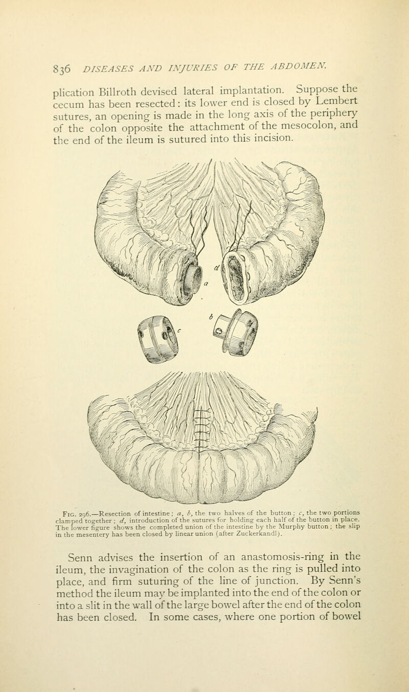 plication Billroth devised lateral implantation. Suppose the cecum has been resected: its lower end is closed by Lembert sutures, an opening is made in the long axis of the periphery of the colon opposite the attachment of the mesocolon, and the end of the ileum is sutured into this incision. Fig. 296.—Resection of intestine ; a. b, the tw - Lu.-_- t the button; c, the two portions clamped together; d, introduction of the sutures for holding each half of the button in place. The lower figure shows the conapleted union of the intestine by the Murphy button; the slip in the mesentery has been closed by linear union (after Zuckerkandl;. Senn advises the insertion of an anastomosis-ring in the ileum, the invagination of the colon as the ring is pulled into place, and firm suturing of the line of junction. By Senn's method the ileum may be implanted into the end of the colon or into a slit in the wall of the large bowel after the end of the colon has been closed. In some cases, where one portion of bowel