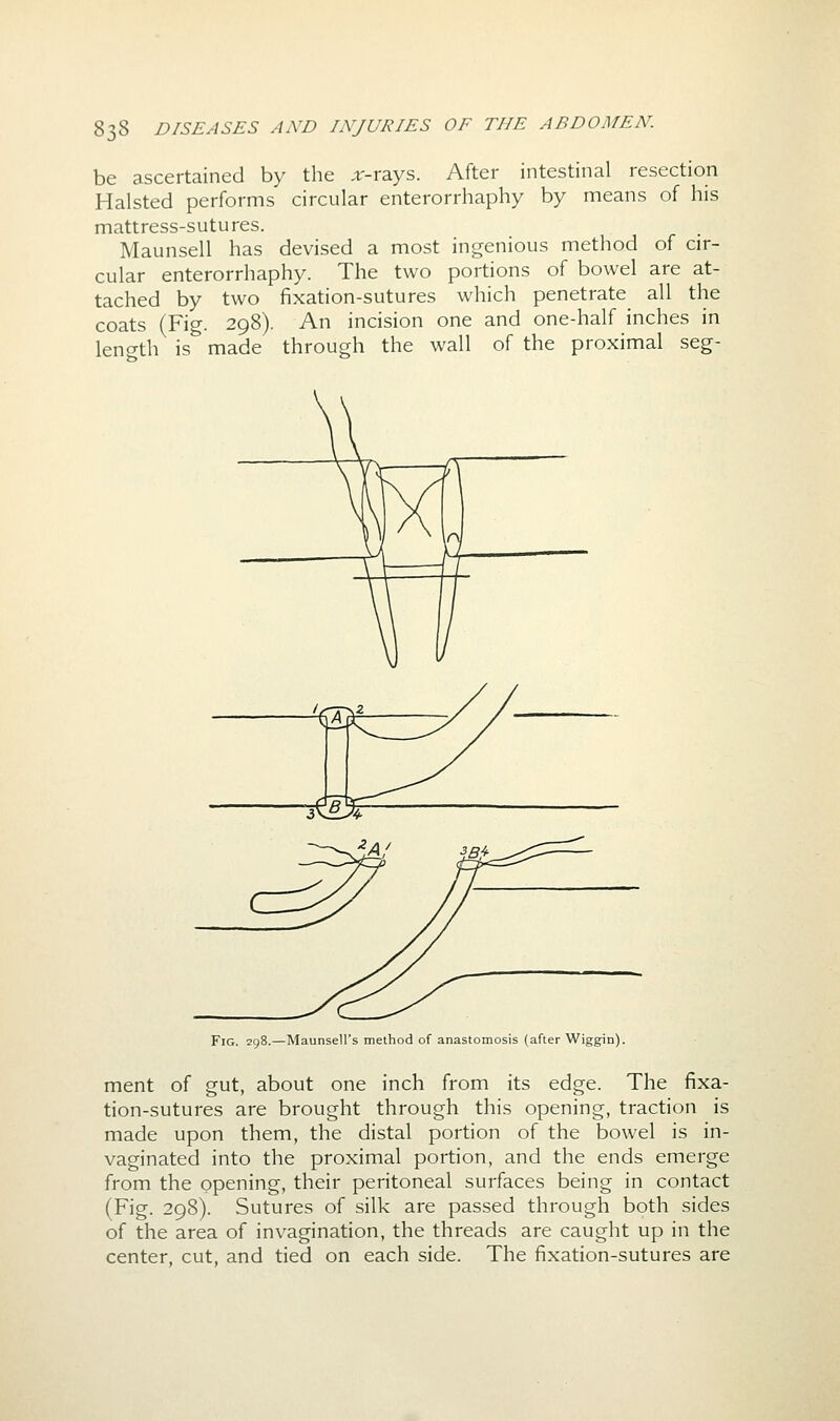be ascertained by the ,r-rays. After intestinal resection Halsted performs circular enterorrhaphy by means of his mattress-sutures. Maunsell has devised a most ingenious method of cir- cular enterorrhaphy. The two portions of bowel are at- tached by two fixation-sutures which penetrate all the coats (Fig. 298). An incision one and one-half inches in length is made through the wall of the proximal seg- FlG. 2Q -Maunsell's method of anastomosis (after Wiggin). ment of gut, about one inch from its edge. The fixa- tion-sutures are brought through this opening, traction is made upon them, the distal portion of the bowel is in- vaginated into the proximal portion, and the ends emerge from the opening, their peritoneal surfaces being in contact (Fig. 298). Sutures of silk are passed through both sides of the area of invagination, the threads are caught up in the center, cut, and tied on each side. The fixation-sutures are