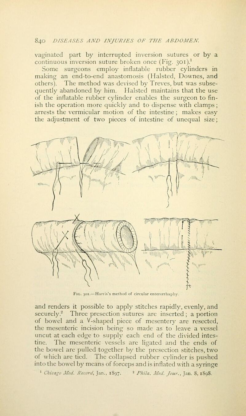 vaginated part by interrupted inversion sutures or by a continuous inversion suture broken once (Fig. 301).^ Some surgeons employ inflatable rubber cylinders in making an end-to-end anastomosis (Halsted, Downes, and others). The method was devised by Treves, but was subse- quently abandoned by him. Halsted maintains that the use of the inflatable rubber cylinder enables the surgeon to fin- ish the operation more quickly and to dispense with clamps; arrests the vermicular motion of the intestine; makes easy the adjustment of two pieces of intestine of unequal size; Fig. 301.—Harris's method of circular enterorrhaphy. and renders it possible to apply stitches rapidly, evenly, and securely.^ Three presection sutures are inserted; a portion of bowel and a V-shaped piece of mesentery are resected, the mesenteric incision being so made as to leave a ves.sel uncut at each edge to supply each end of the divided intes- tine. The mesenteric vessels are ligated and the ends of the bowel are pulled together by the presection stitches, two of which are tied. The collapsed rubber cylinder is pushed into the bowel by means of forceps and is inflated with a syringe ' Chicago Med. Record, Jan., 1897. ' Phila. Med. Jour., Jan. 8, 1898.