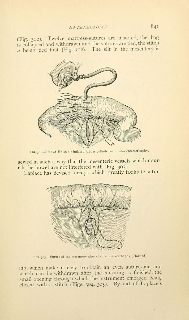 (Fig. 302). Twelve mattress-sutures are inserted, the bag is collapsed and withdrawn and the sutures are tied, the stitch a being tied first (Fig. 302). The slit in the mesenter>- is Fig. :!02.—Use of Halsted's inflated rubber cylinder in circular enterorrhaphy. sewed in such a way that the mesenteric vessels which nour- ish the bowel are not interfered with (Fig. 303). Laplace has devised forceps which greatly facilitate sutur- ■ymiEiF 'i1'%i\W)^J;pi| Fig. 30^.—Suture of the mesentery after circular enterorrhaphy ^Halsted). ing, which make it eas}' to obtain an even suture-line, and which can be withdrawn after the suturing is finished, the small opening through which the instrument emerged being closed with a stitch (Figs. 304. 305). By aid of Laplace's